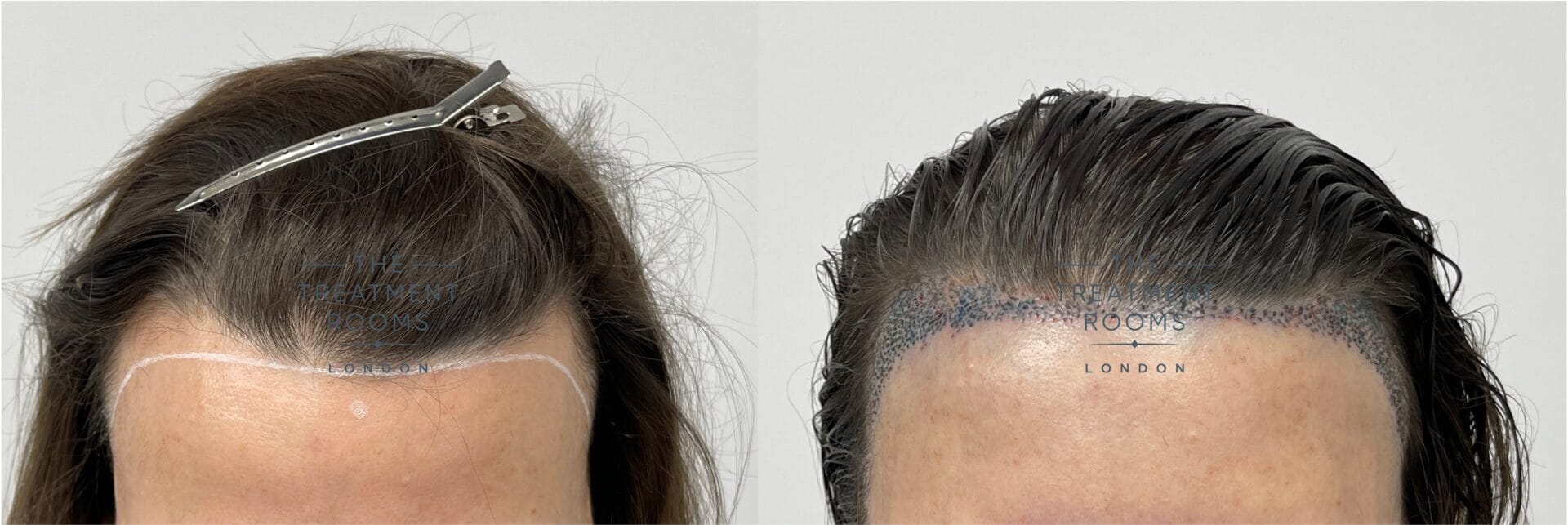 female hairline lowering hair transplant cost