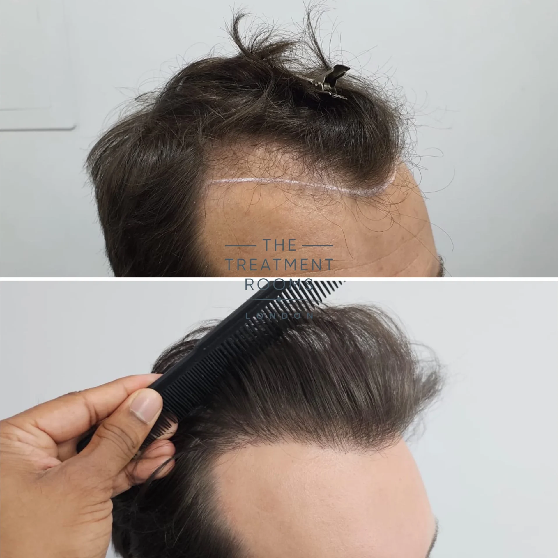 fine hair fue transplant 1385 grafts before and after