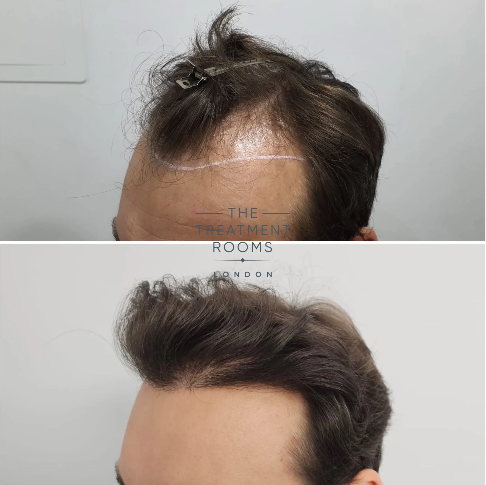 fine hair transplant 1385 grafts before and after