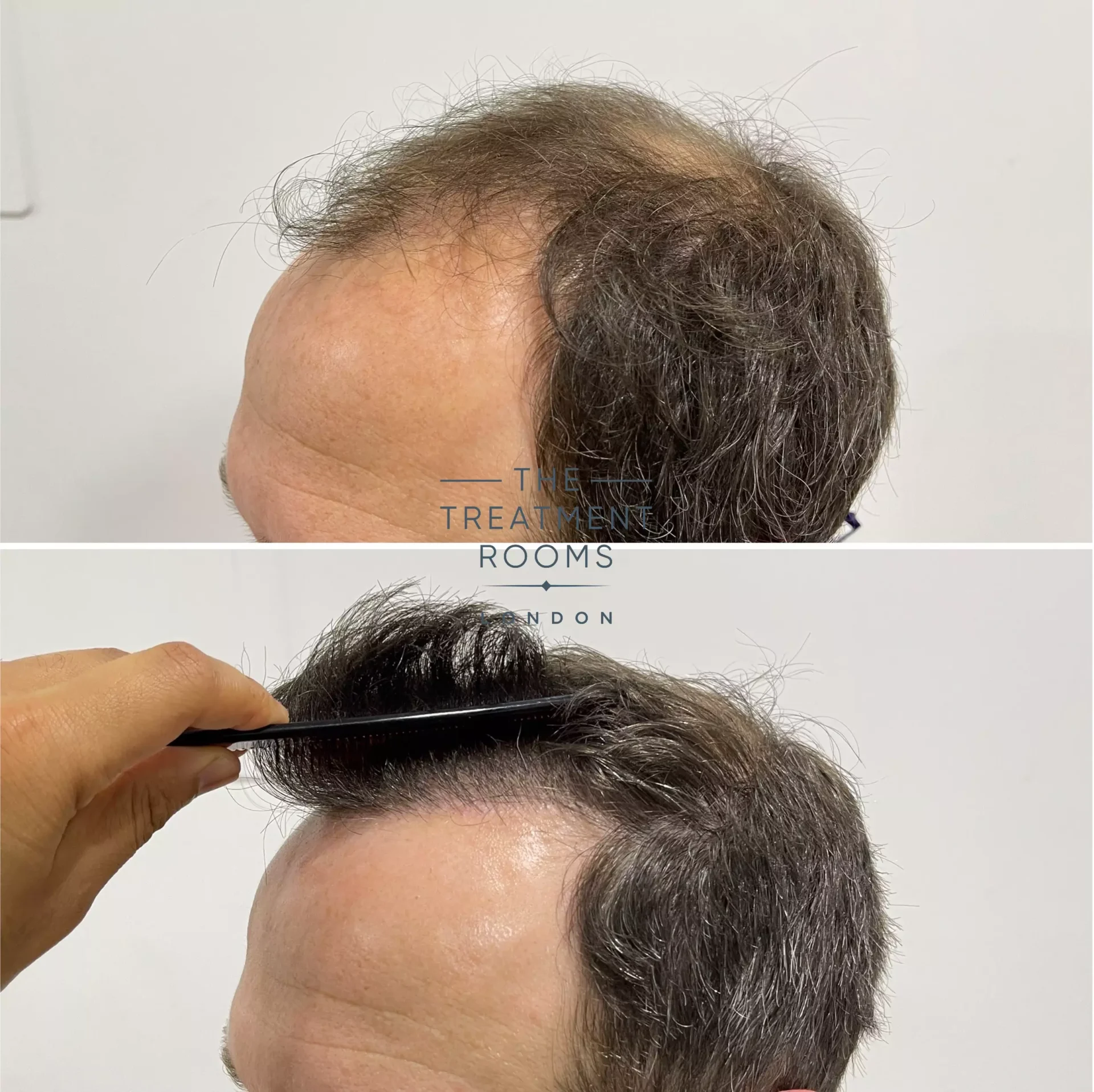 fue clinic 2076 grafts before and after