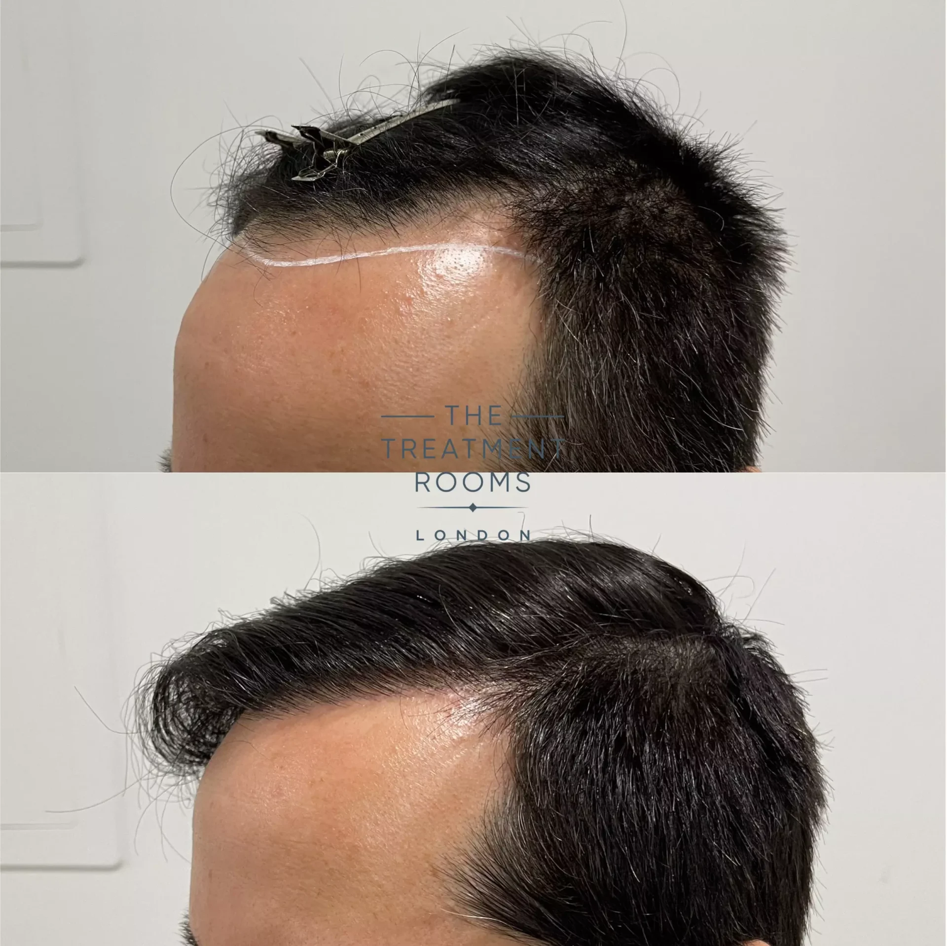 fue clinic before and after surgery 1232 grafts