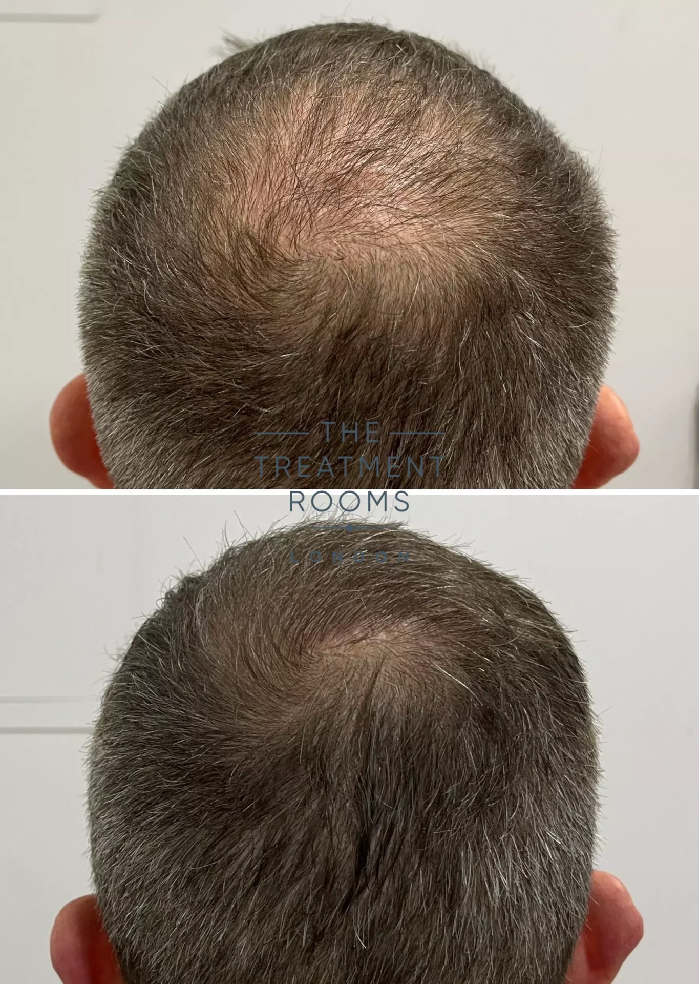 fue clinic crown hair transplant result 1450 grafts