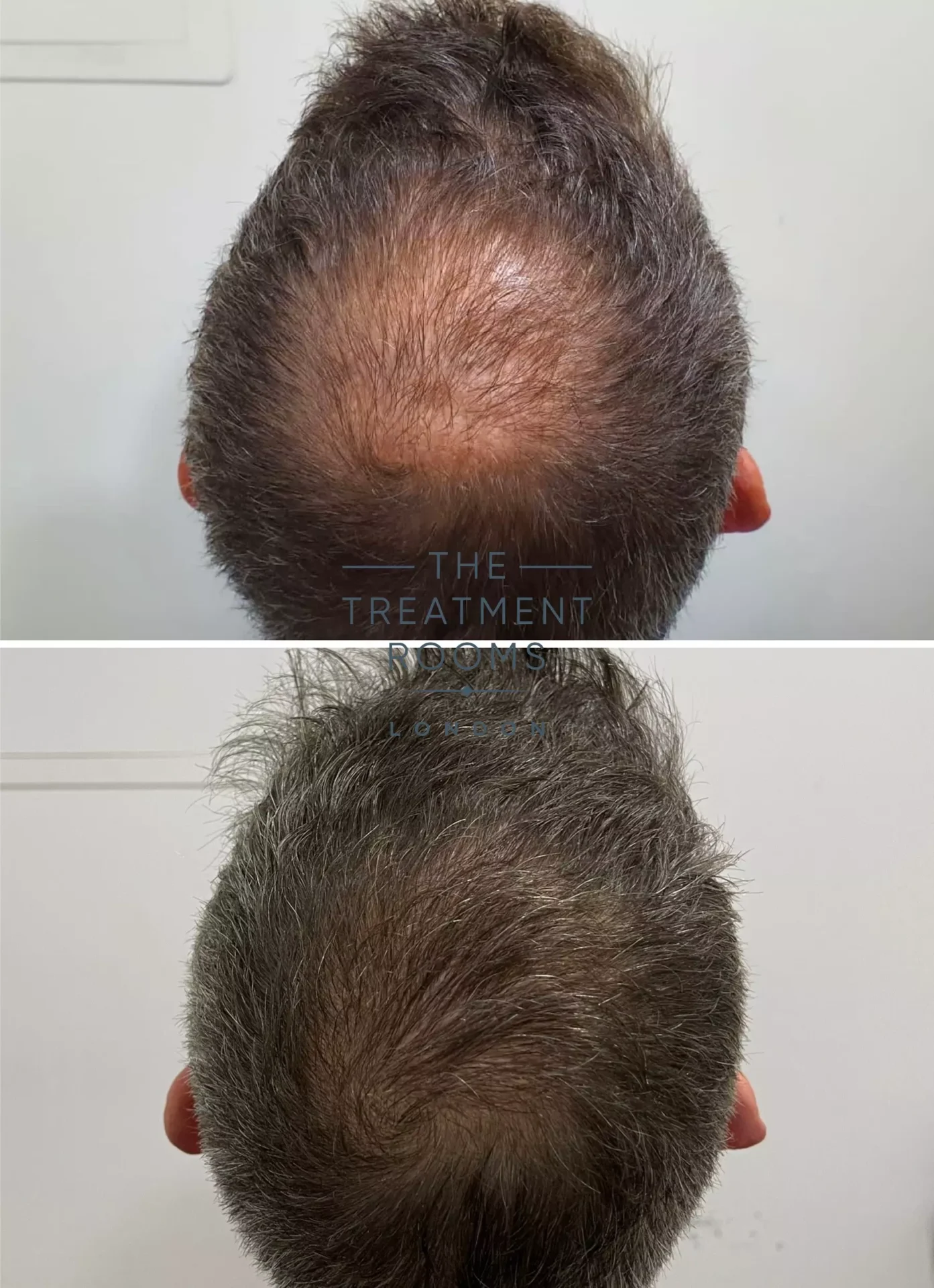 fue clinic crown hair transplant