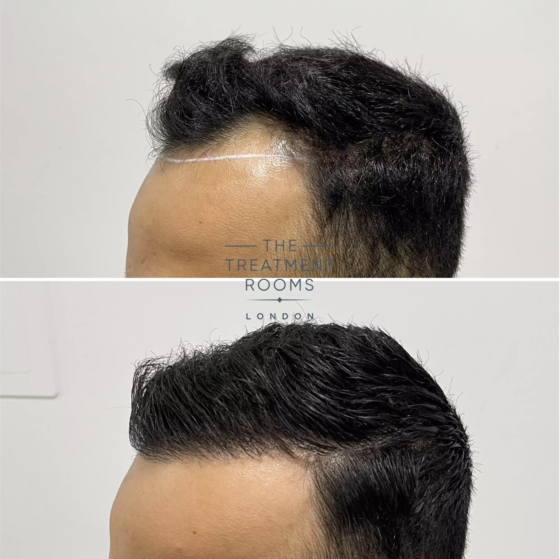 fue clinic london 1274 grafts before and after