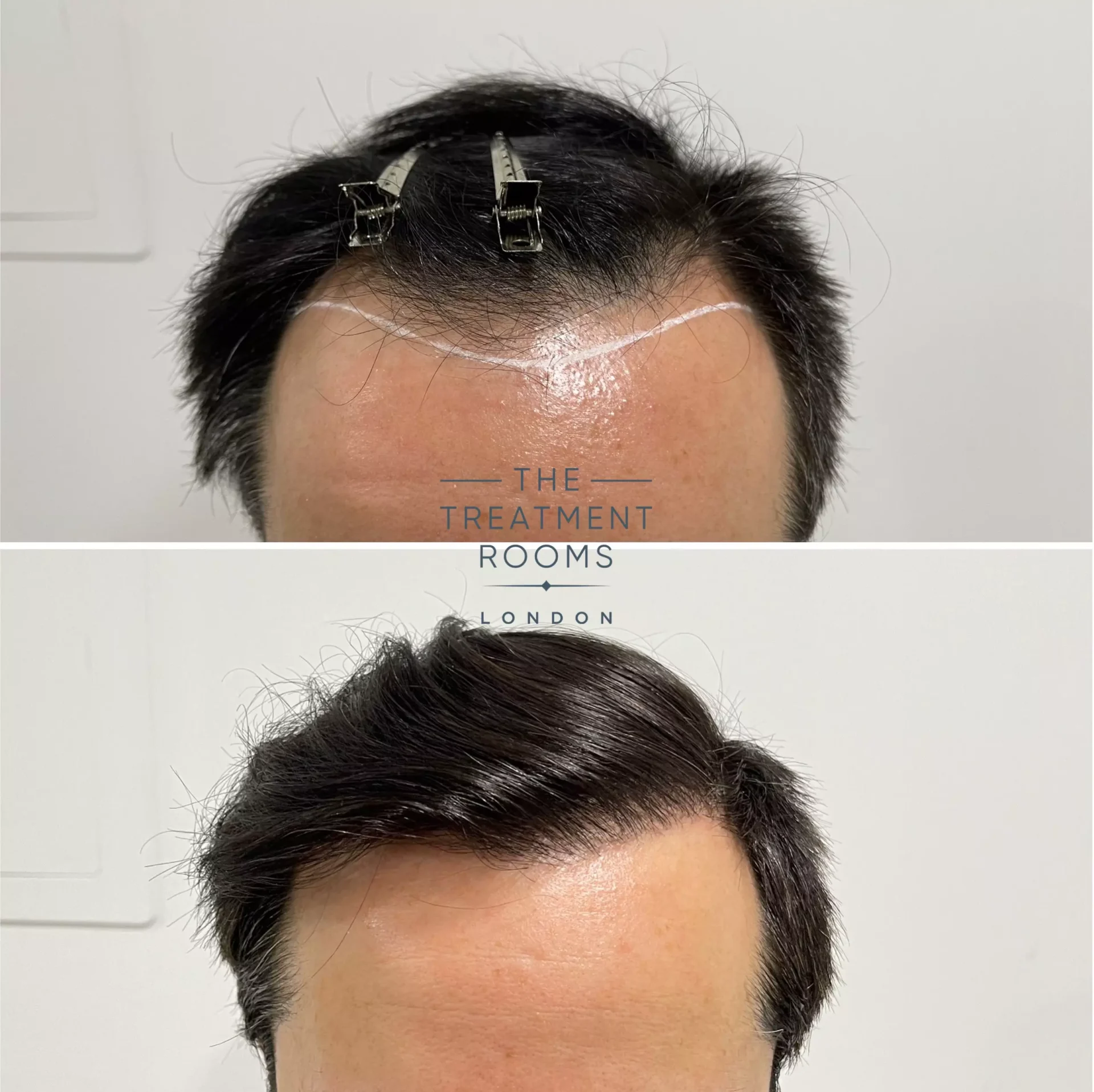 fue clinic london result 1232 grafts