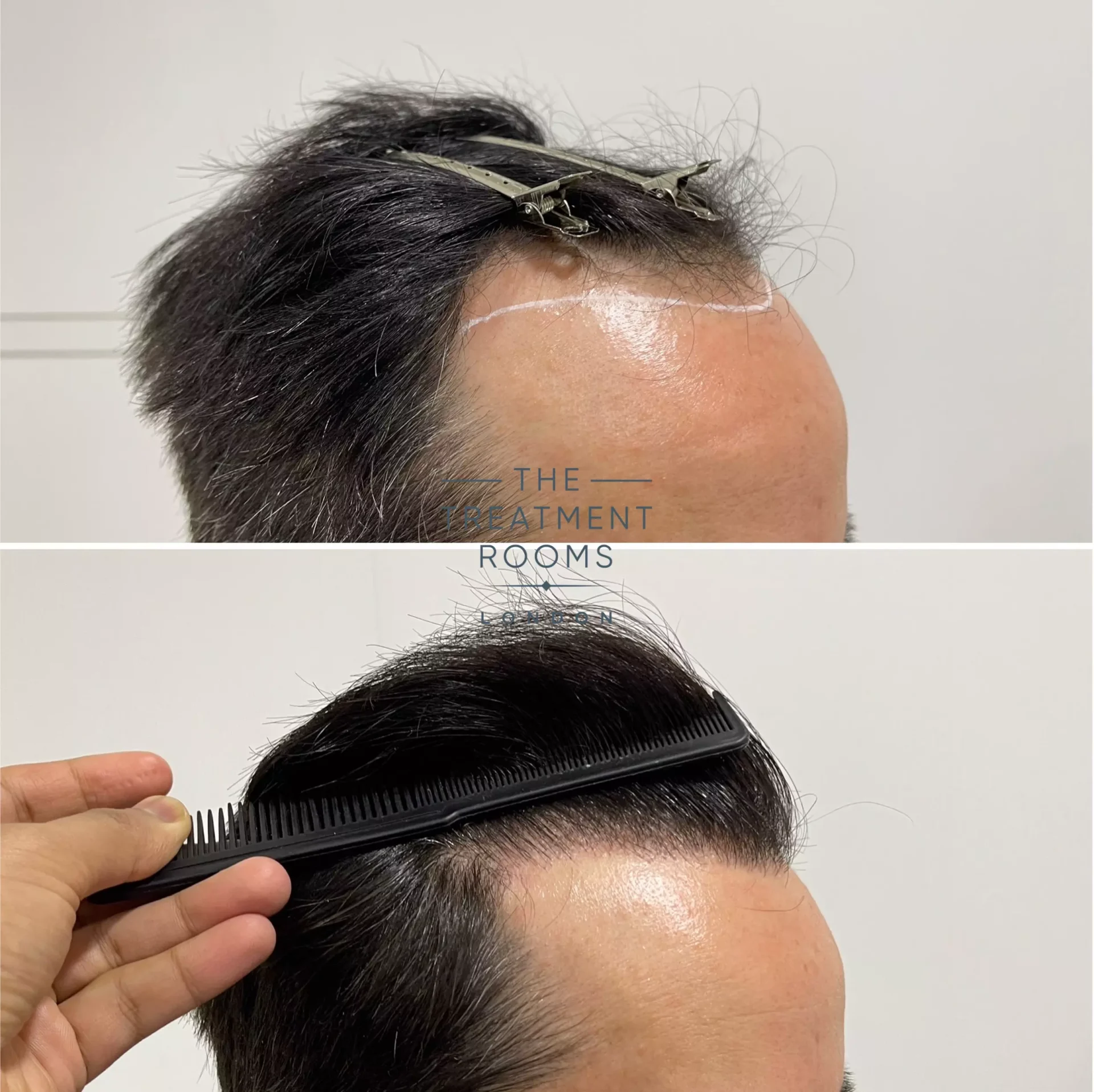 fue clinic receding hairline 1232 grafts result