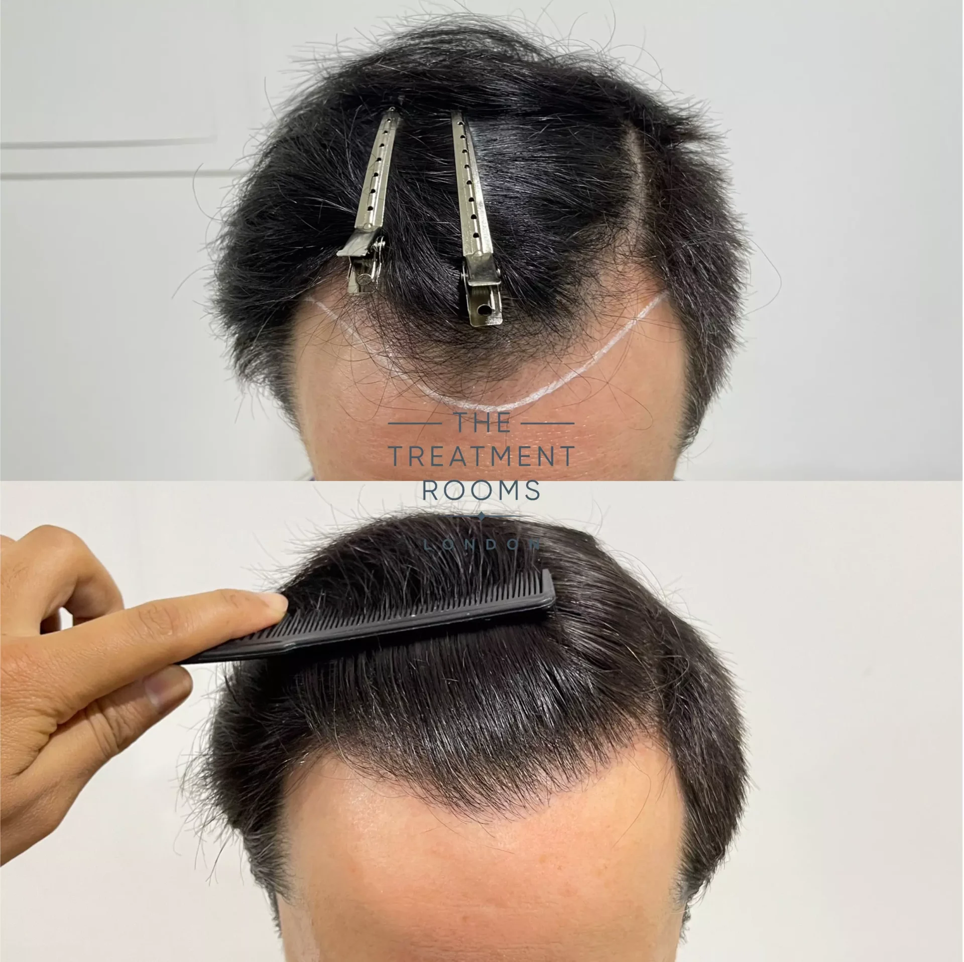 fue clinic result 1232 grafts