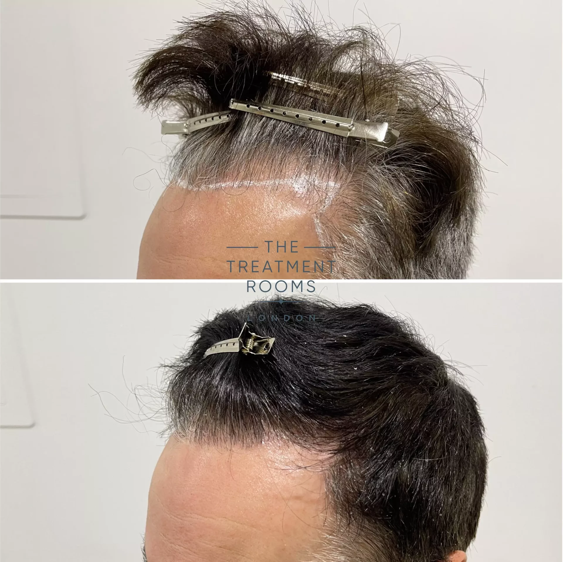 fue hair transplant hairline repair 1264 grafts