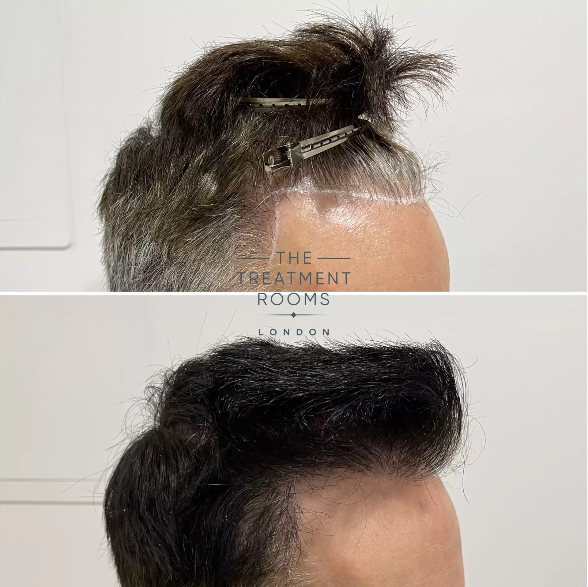 fue hair transplant london repair 1264 grafts