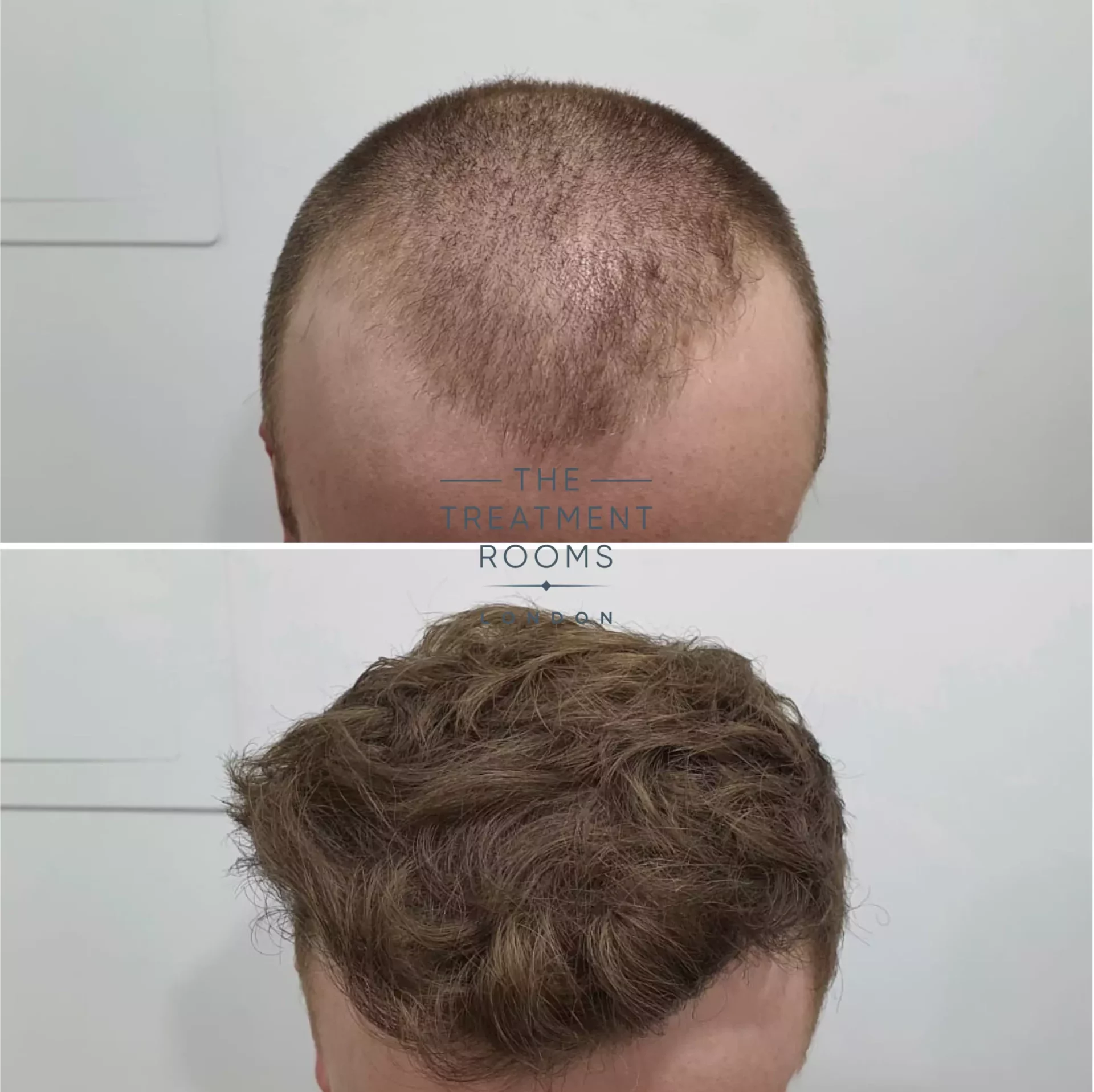 fue hair transplant 1539 grafts before and after