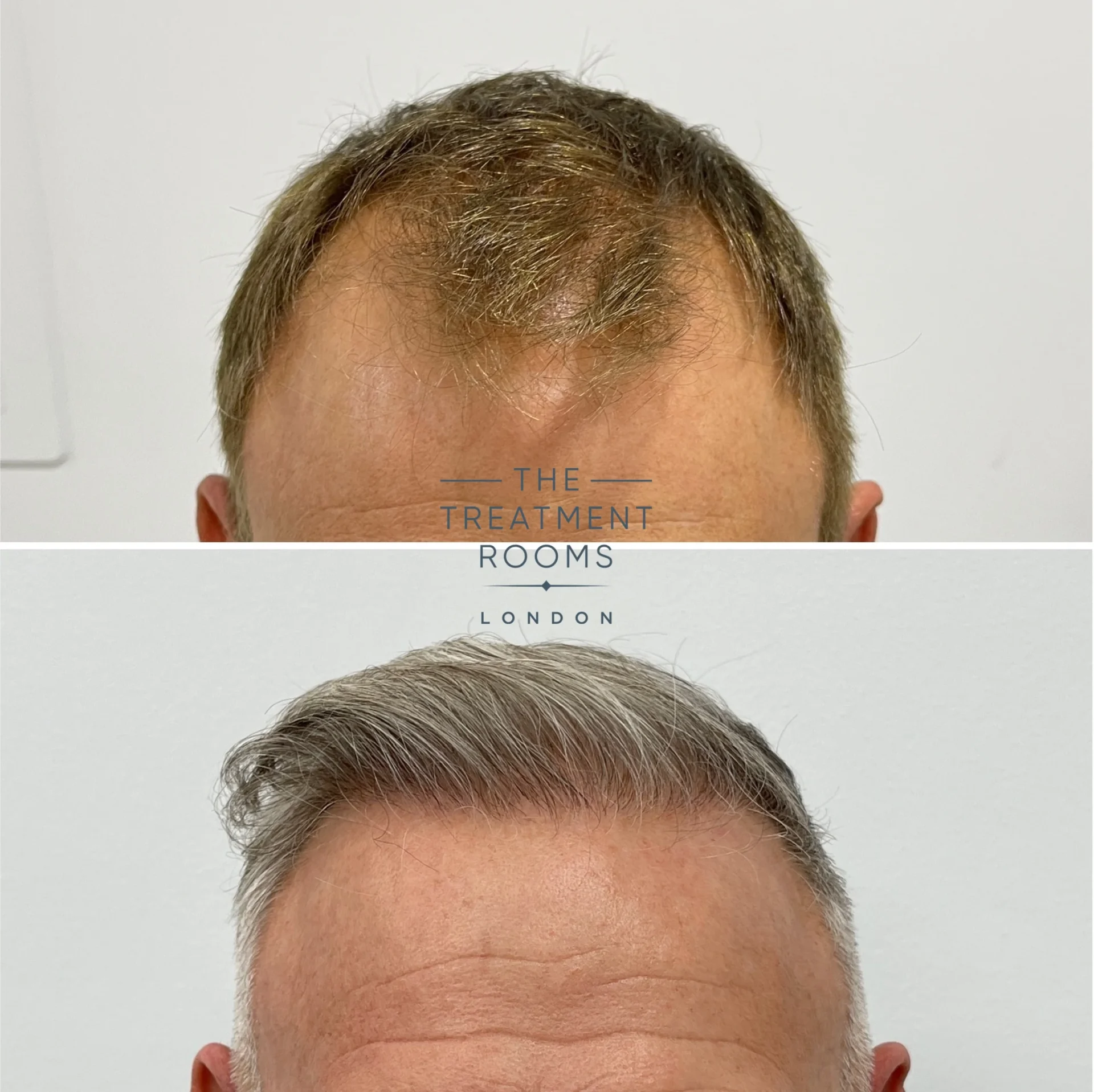 fue hair transplant 1602 grafts before and after.