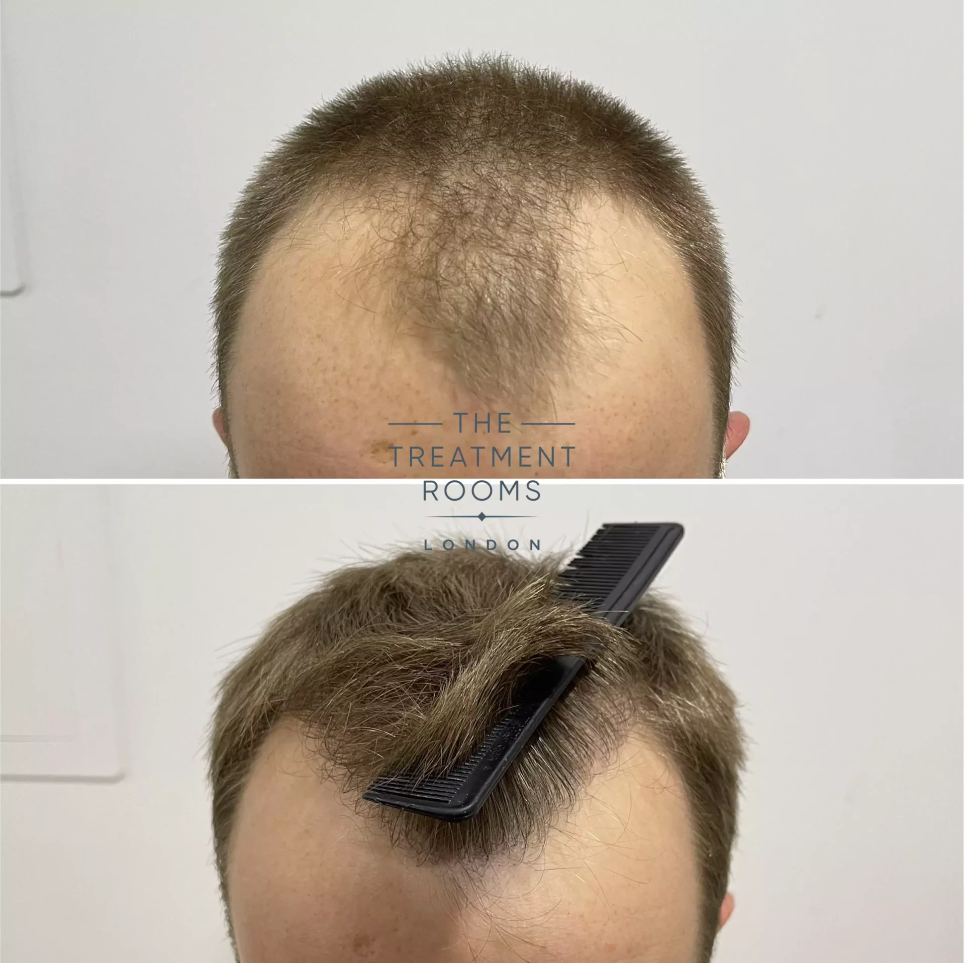 fue hair transplant 1756 before and after