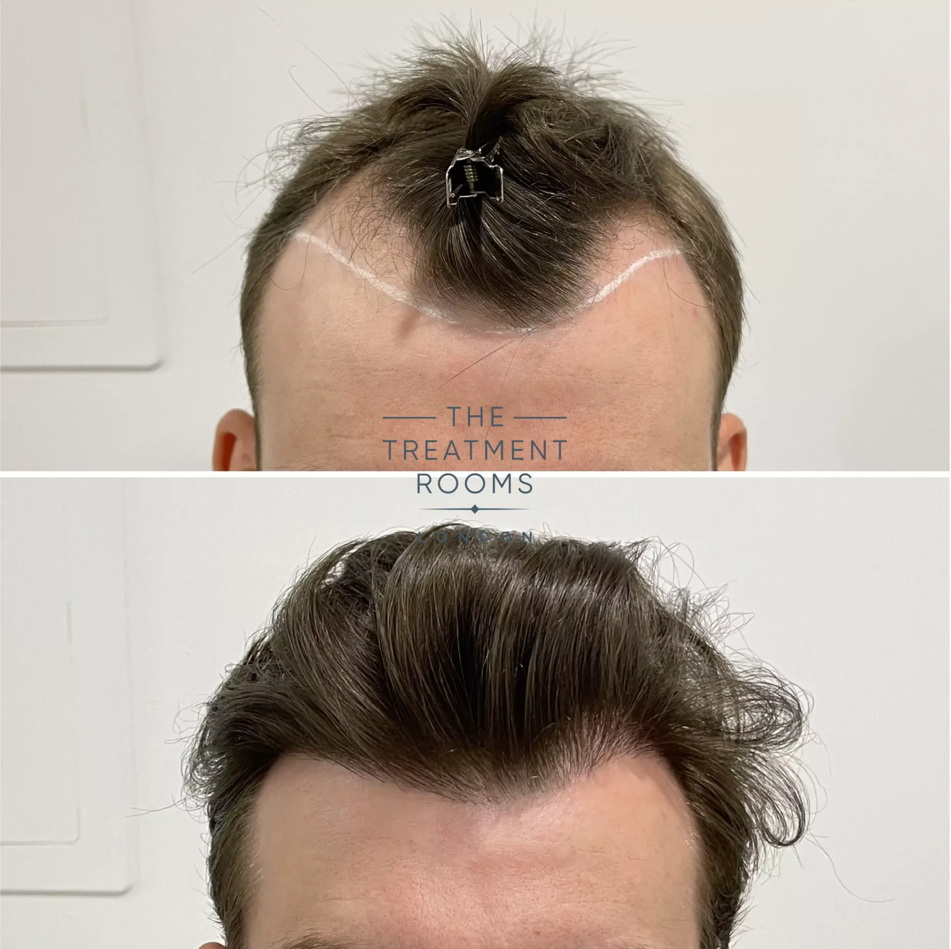 fue hair transplant before and after 1357 grafts