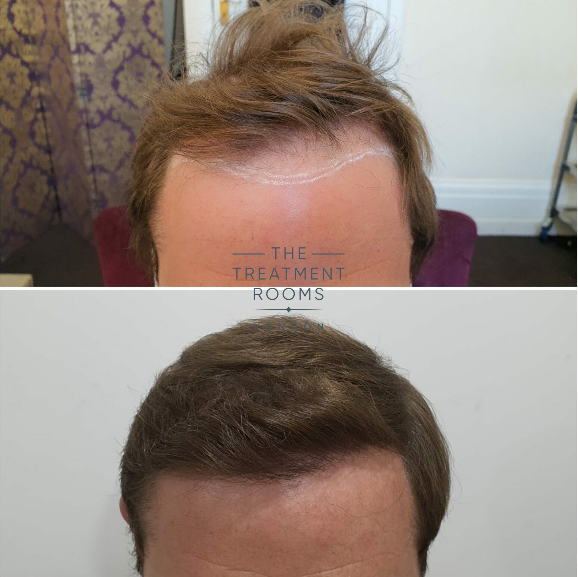 fue hair transplant before and after 2018 grafts