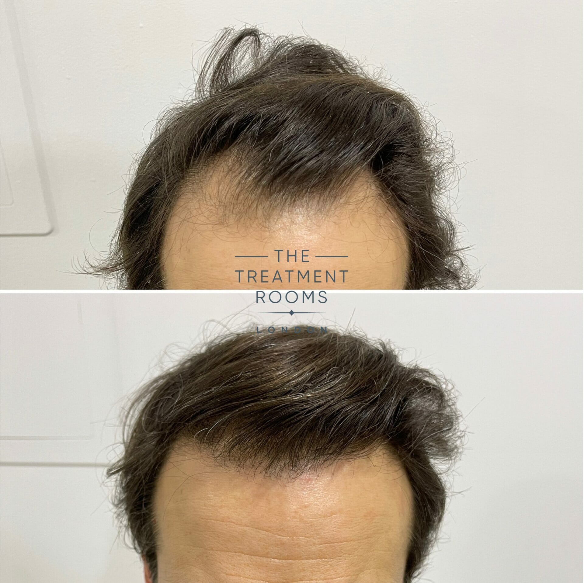 fue hair transplant before and after hairline 1840 grafts