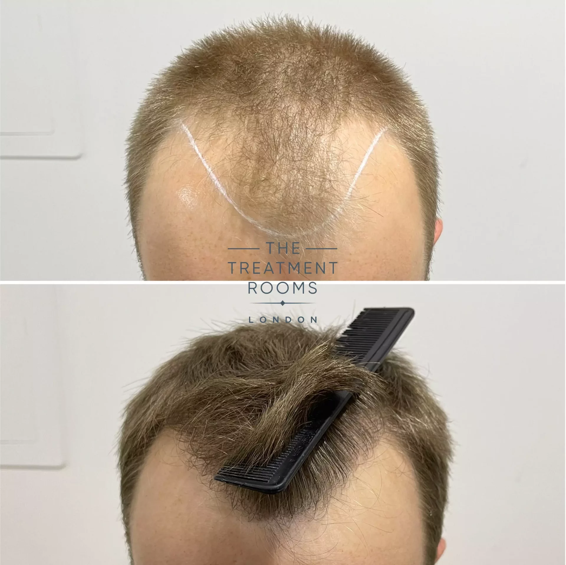 fue hair transplant clinic 1756 grafts before and after