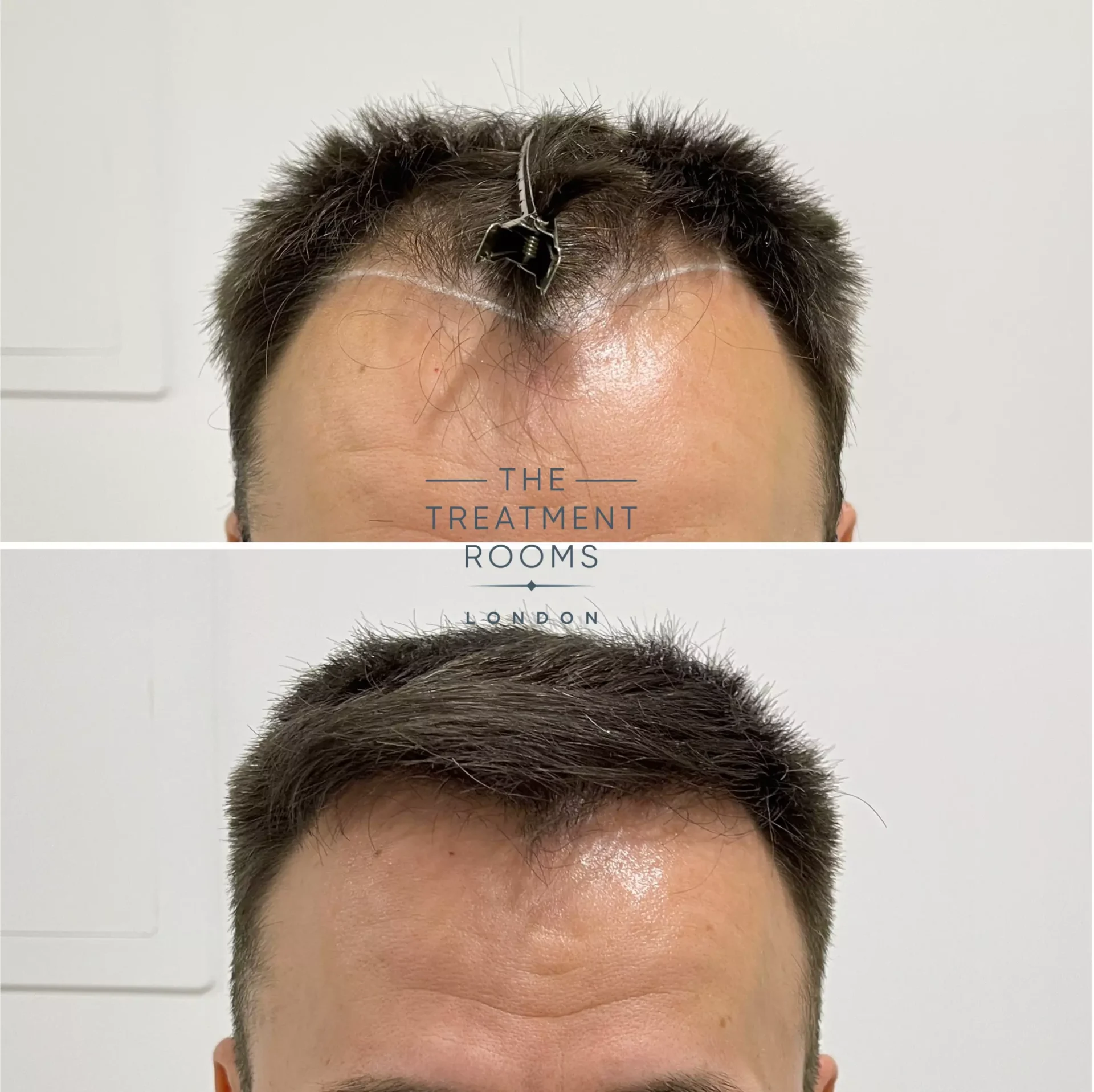 fue hair transplant clinic 1930 grafts before and after