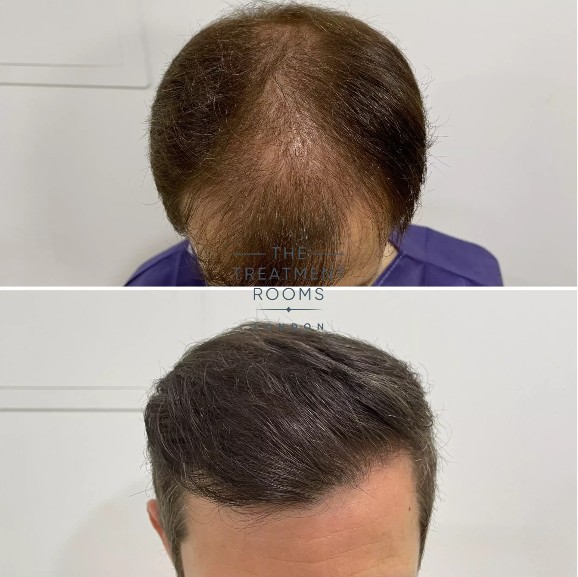 fue hair transplant clinic UK before and after 1491 grafts