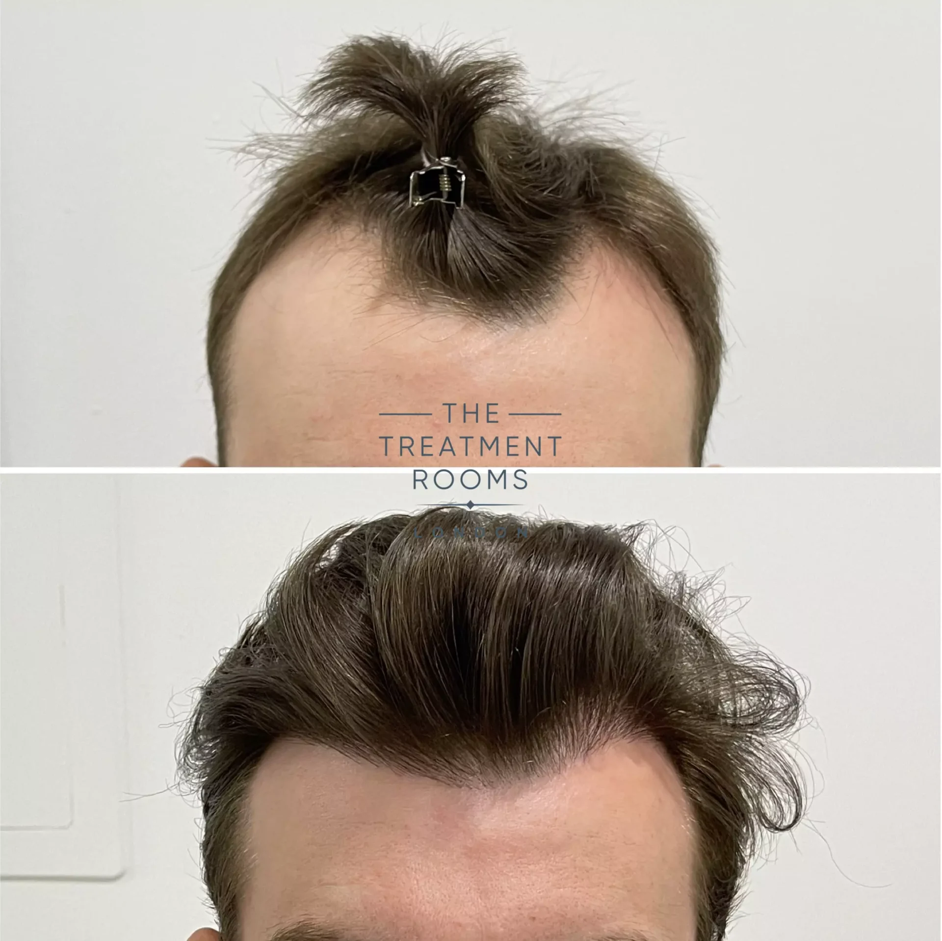 fue hair transplant clinic before and after 1357 grafts