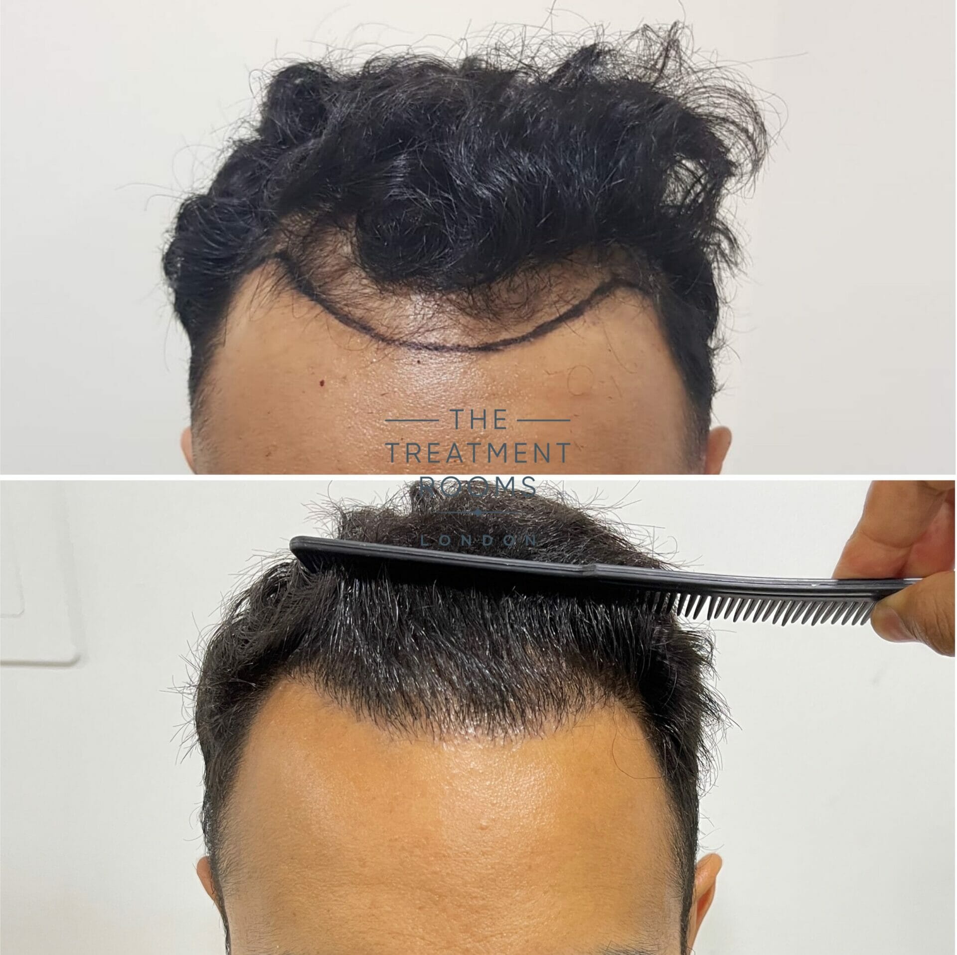 fue hair transplant clinic before and after 1397 grafts