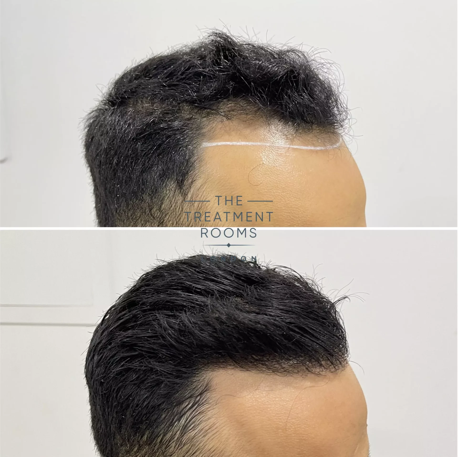 fue hair transplant clinic london 1274 grafts before and after
