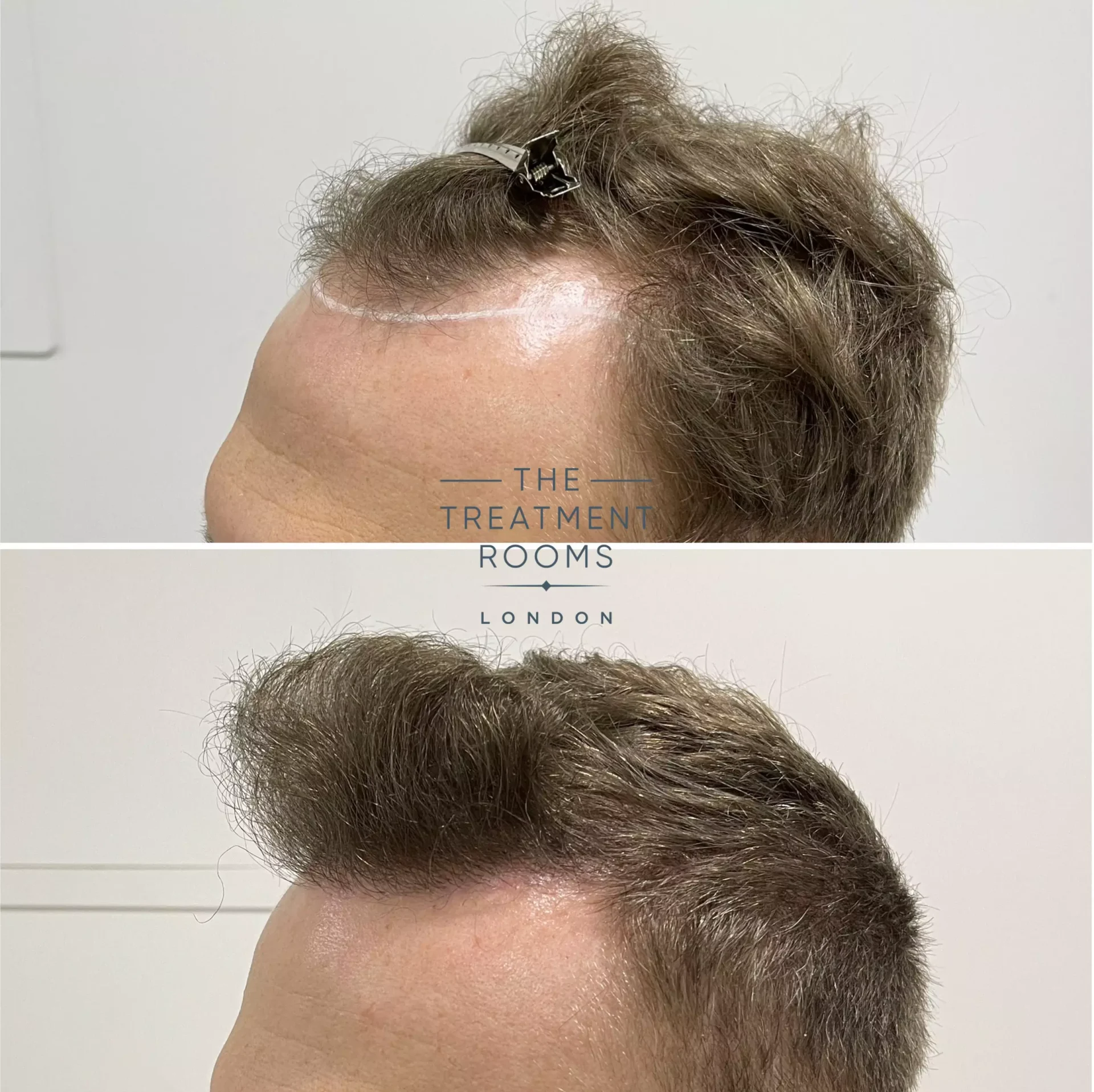 fue hair transplant clinic london 1346 grafts before and after
