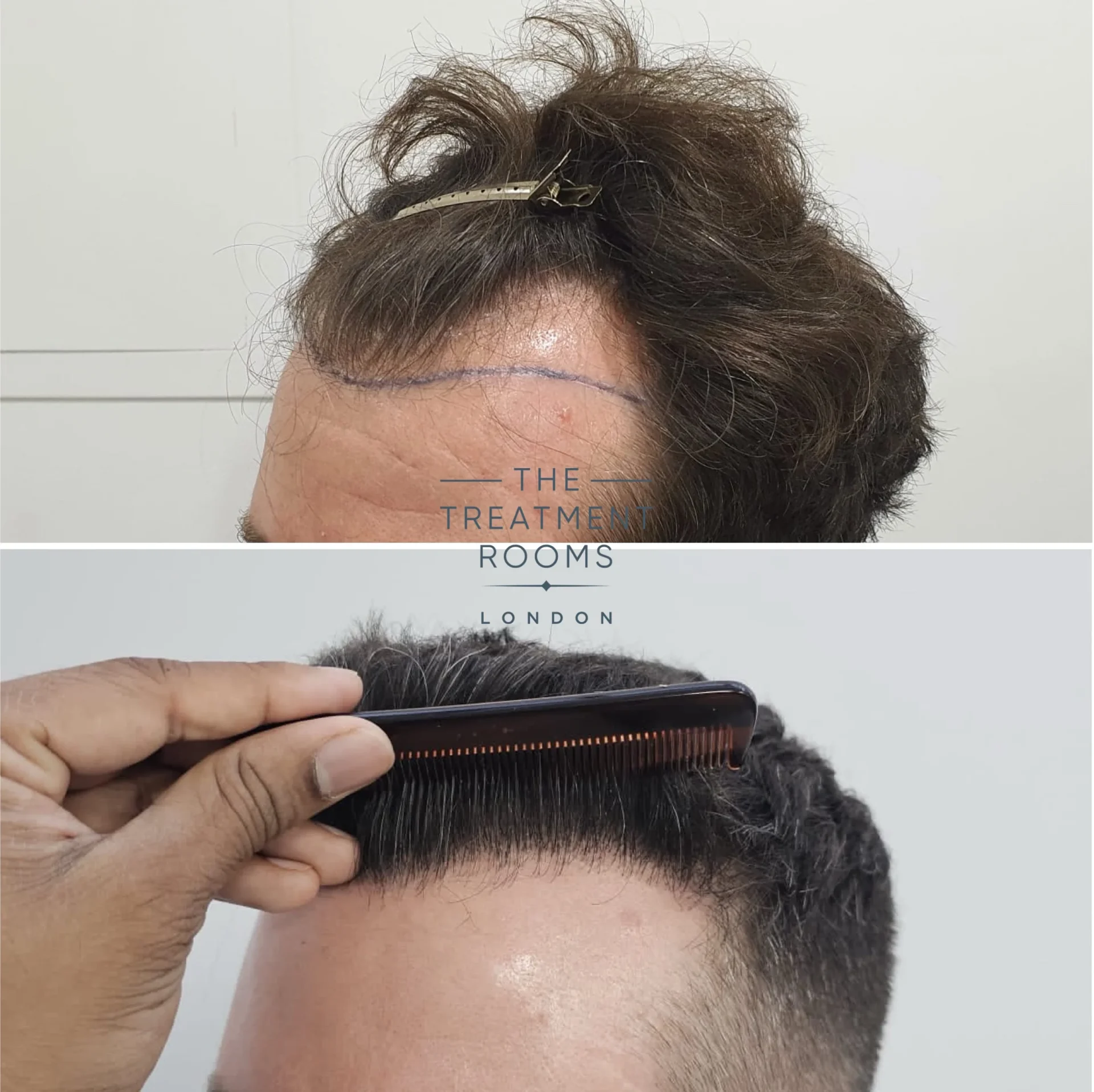 fue hair transplant clinic london 1745 grafts before and after