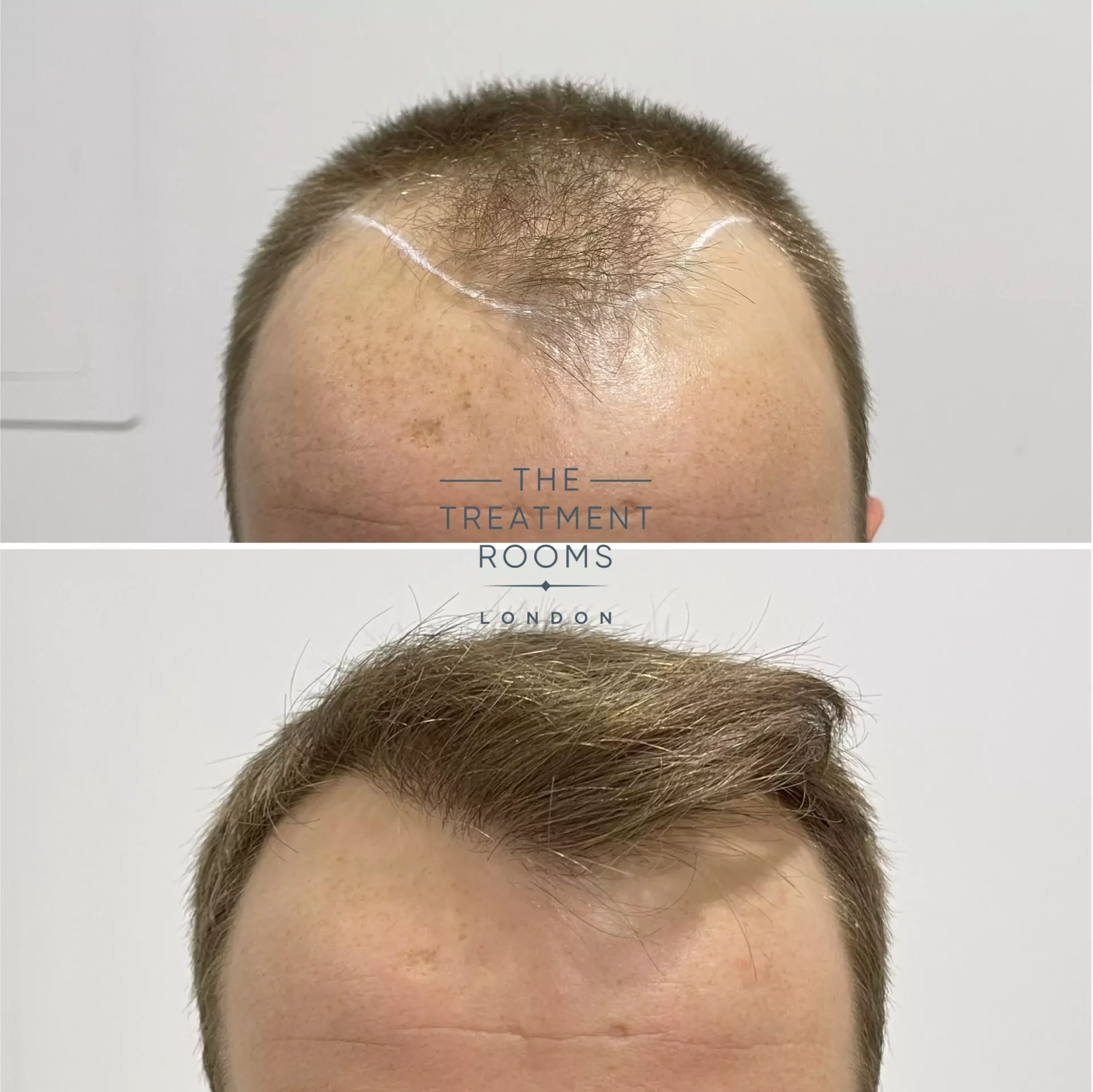 fue hair transplant clinic london 1756 grafts before and after