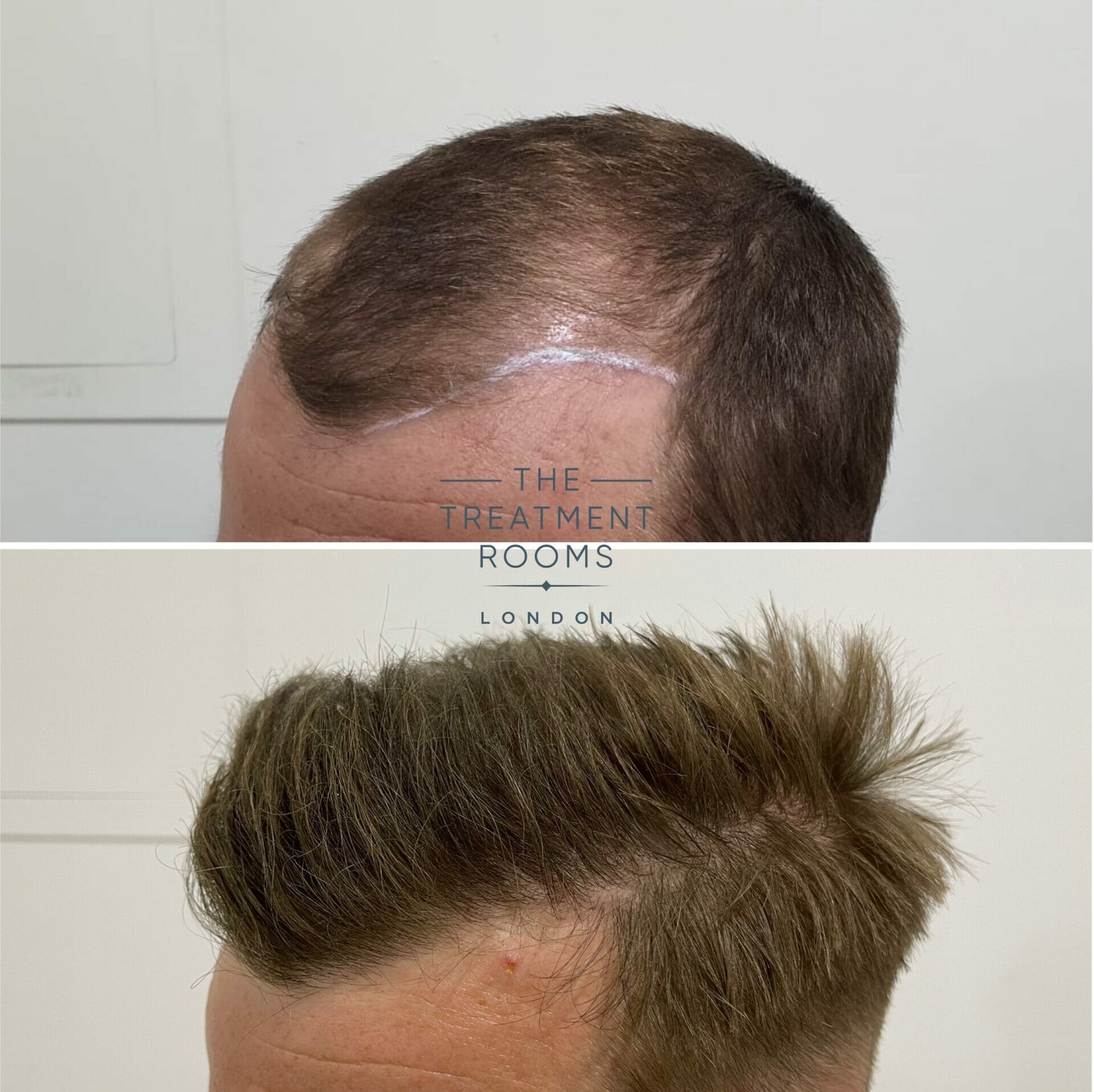 fue hair transplant clinic london before and after hairline surgery