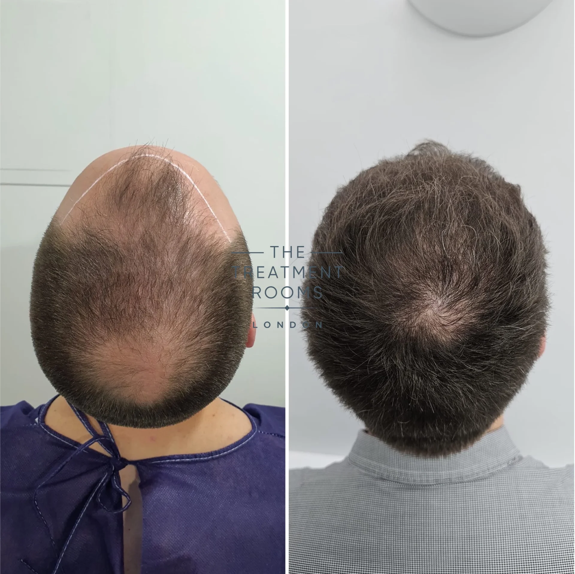 fue hair transplant crown and hairline 3299 grafts