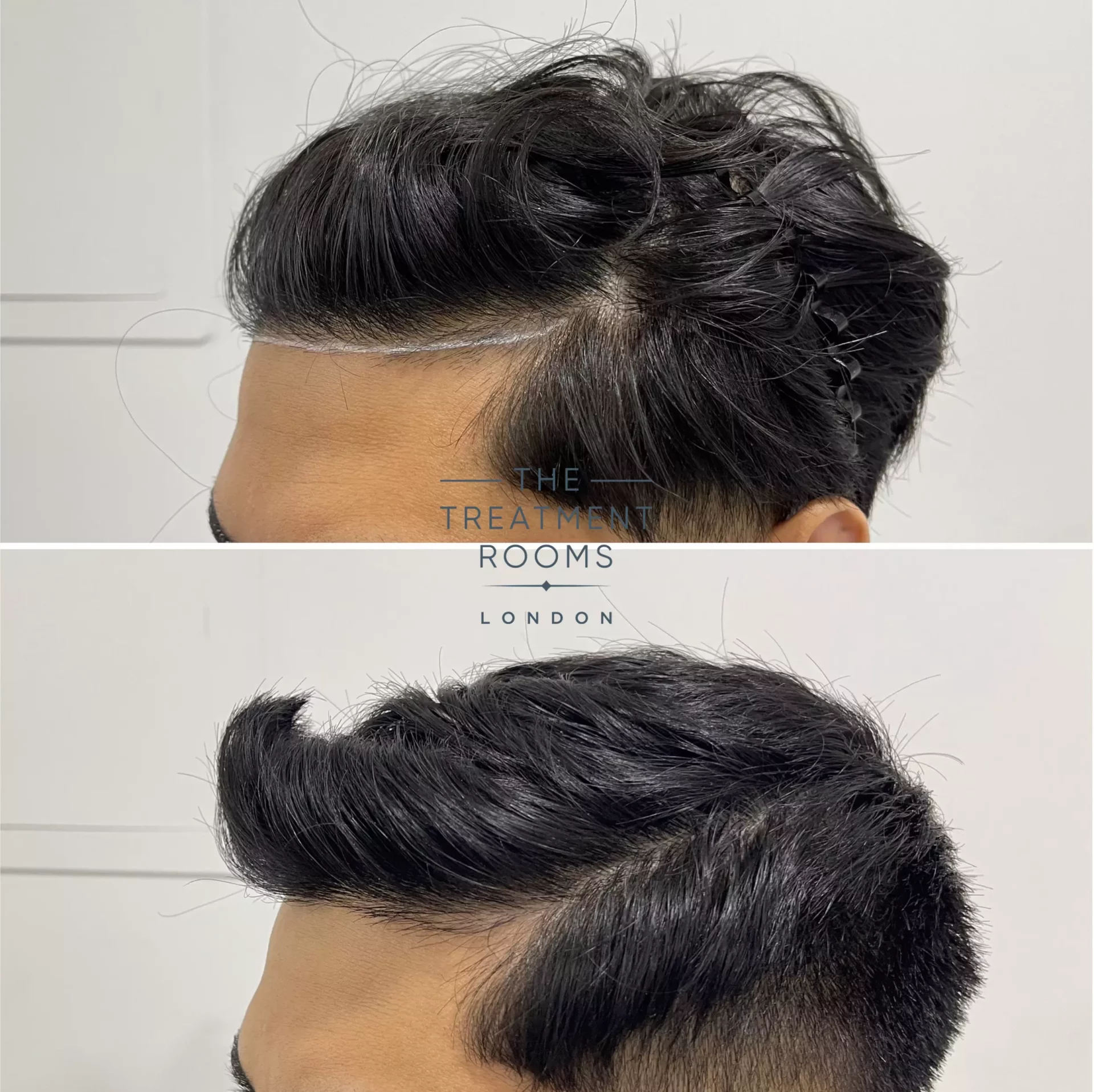 fue hair transplant hairline 1019 grafts