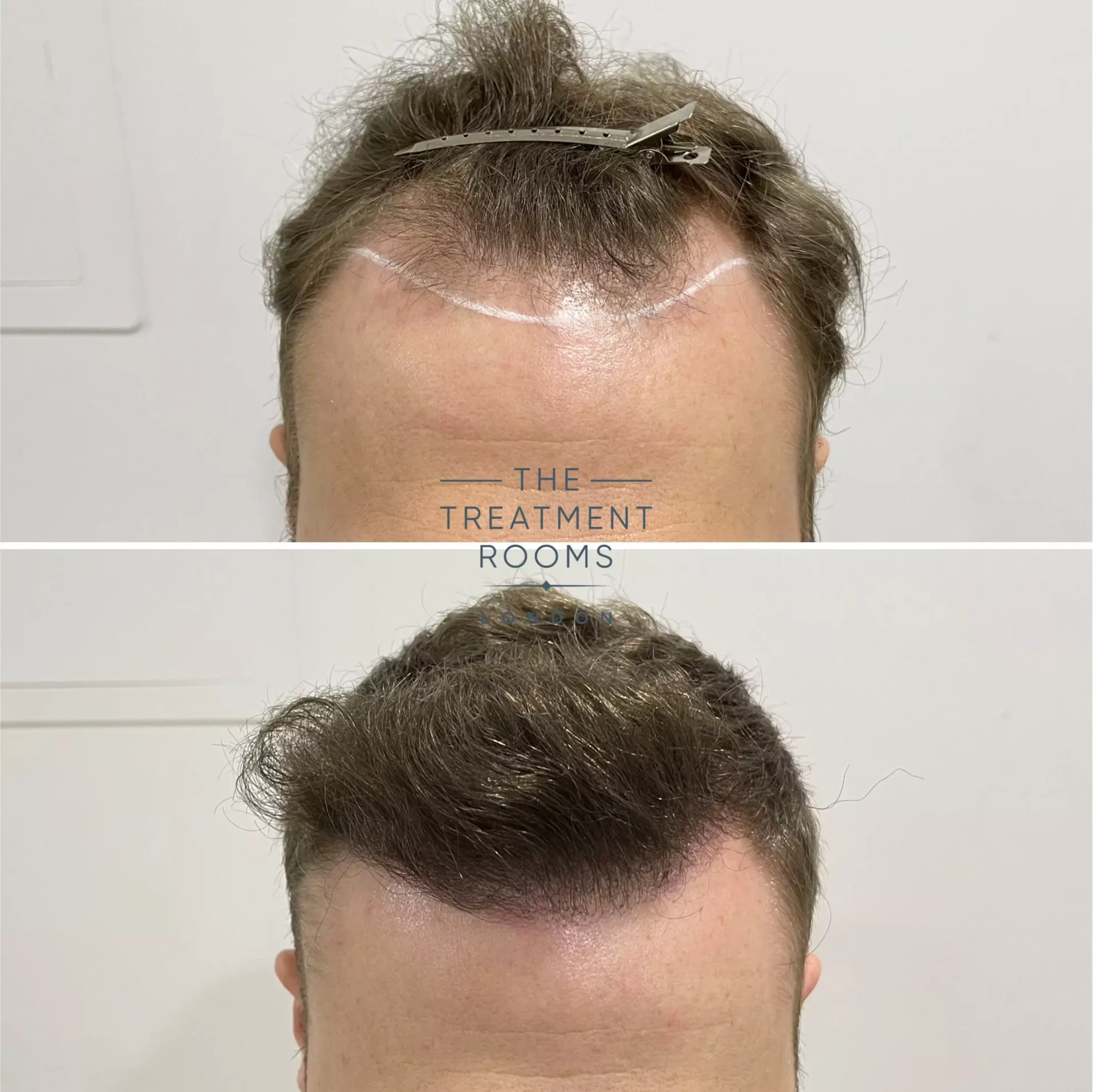 fue hair transplant hairline 1346 grafts before and after