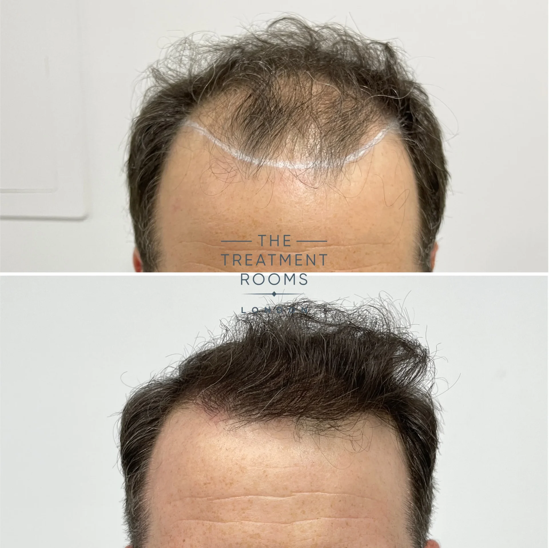 fue hair transplant hairline before and after 1521 grafts