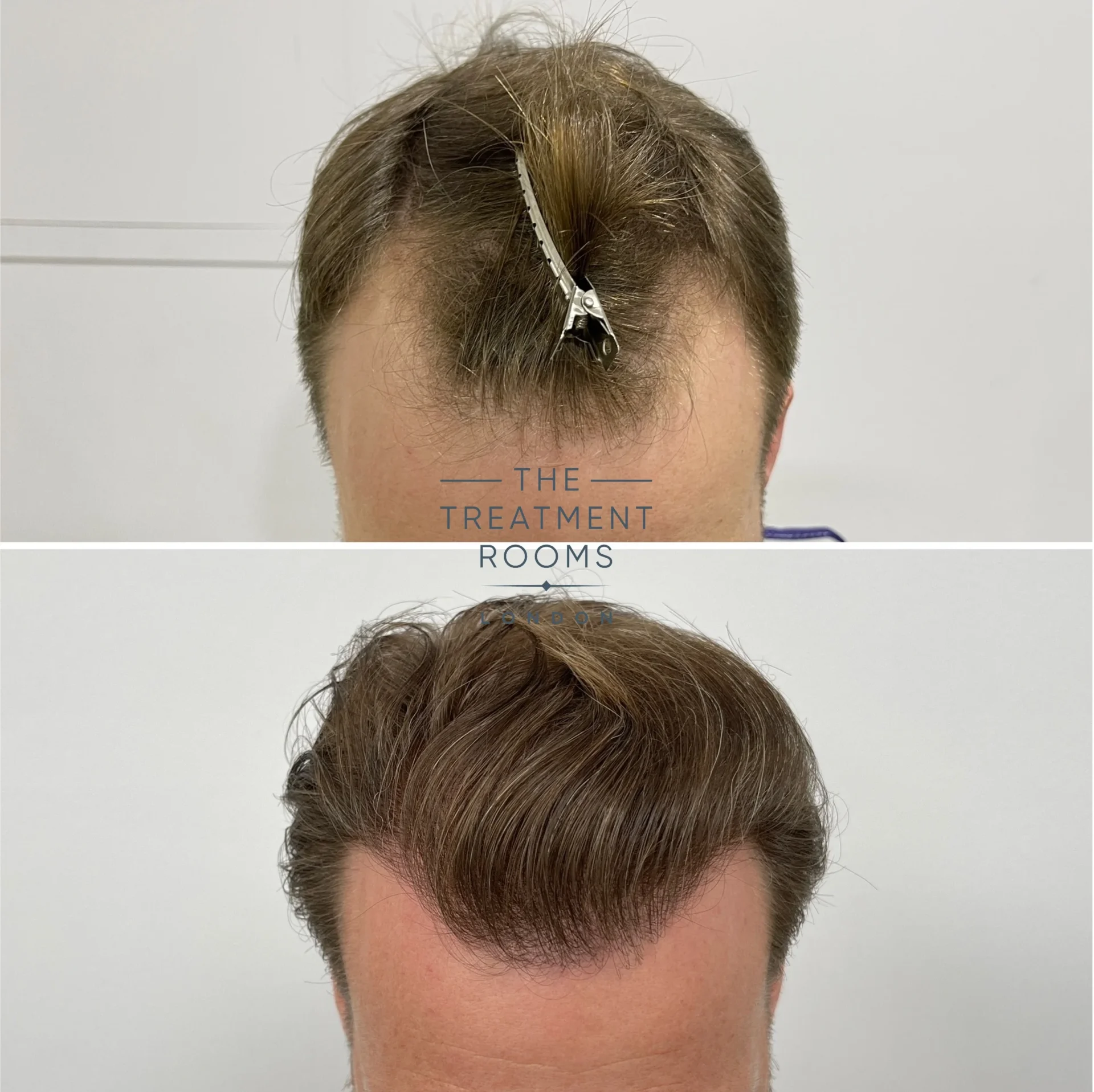 fue hair transplant hairline before and after 1566 grafts