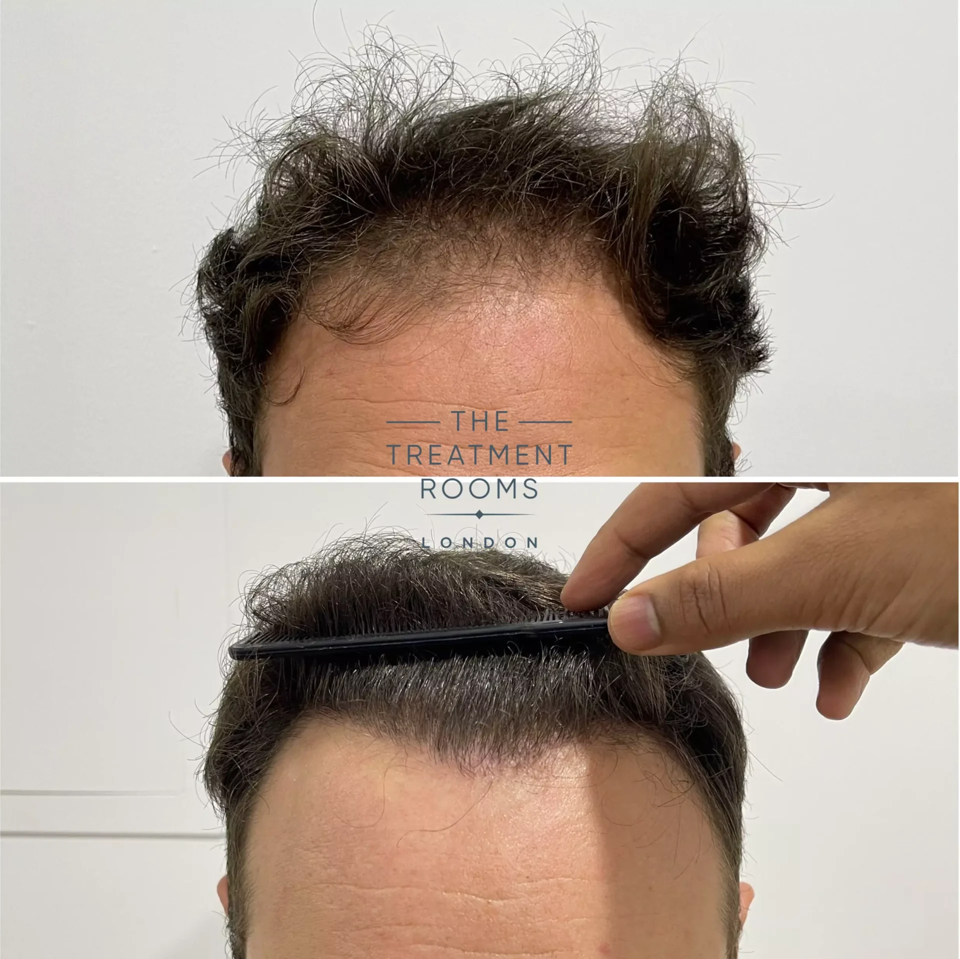 fue hair transplant hairline result 1736 grafts