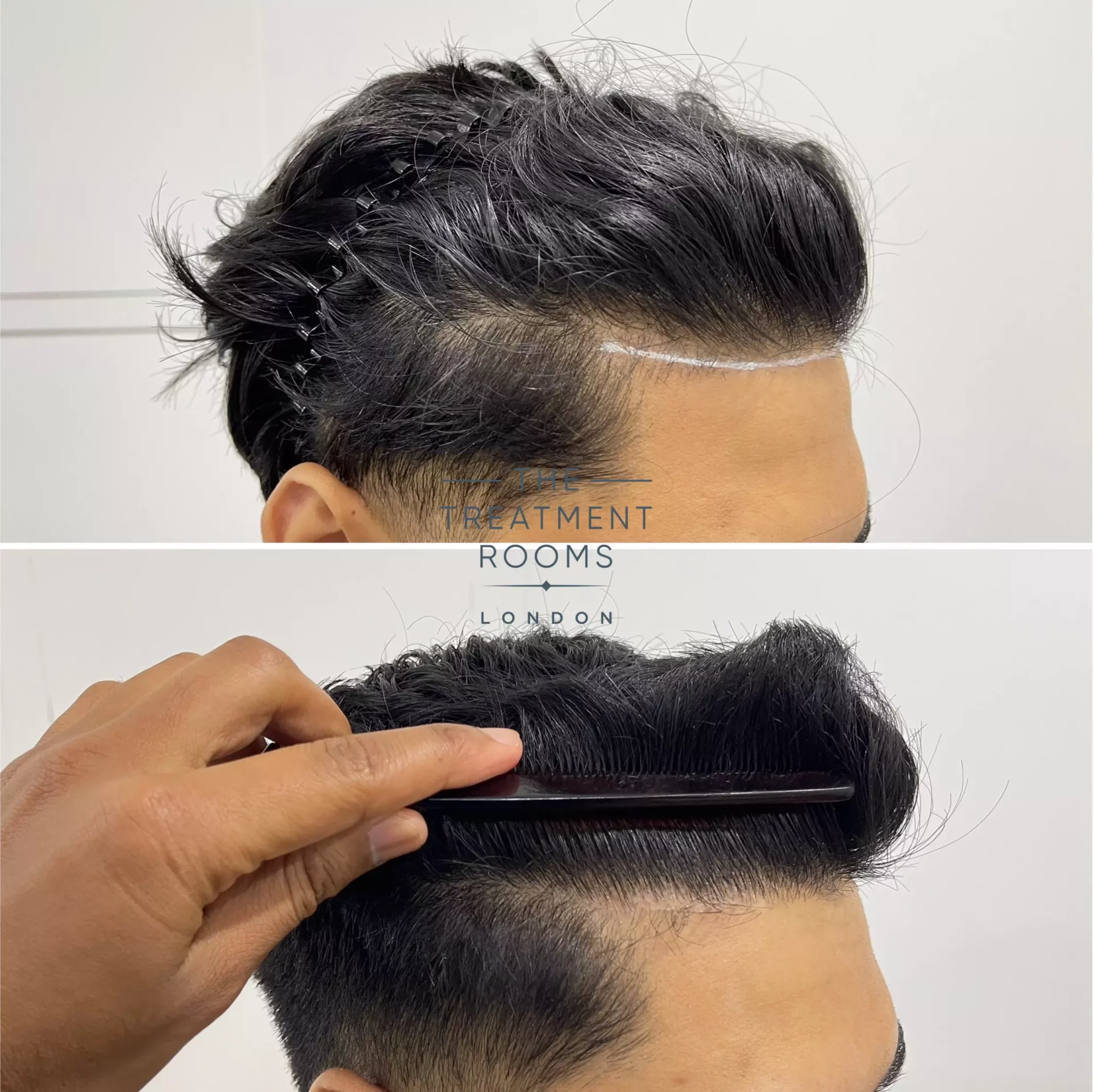 fue hair transplant london 1019 grafts