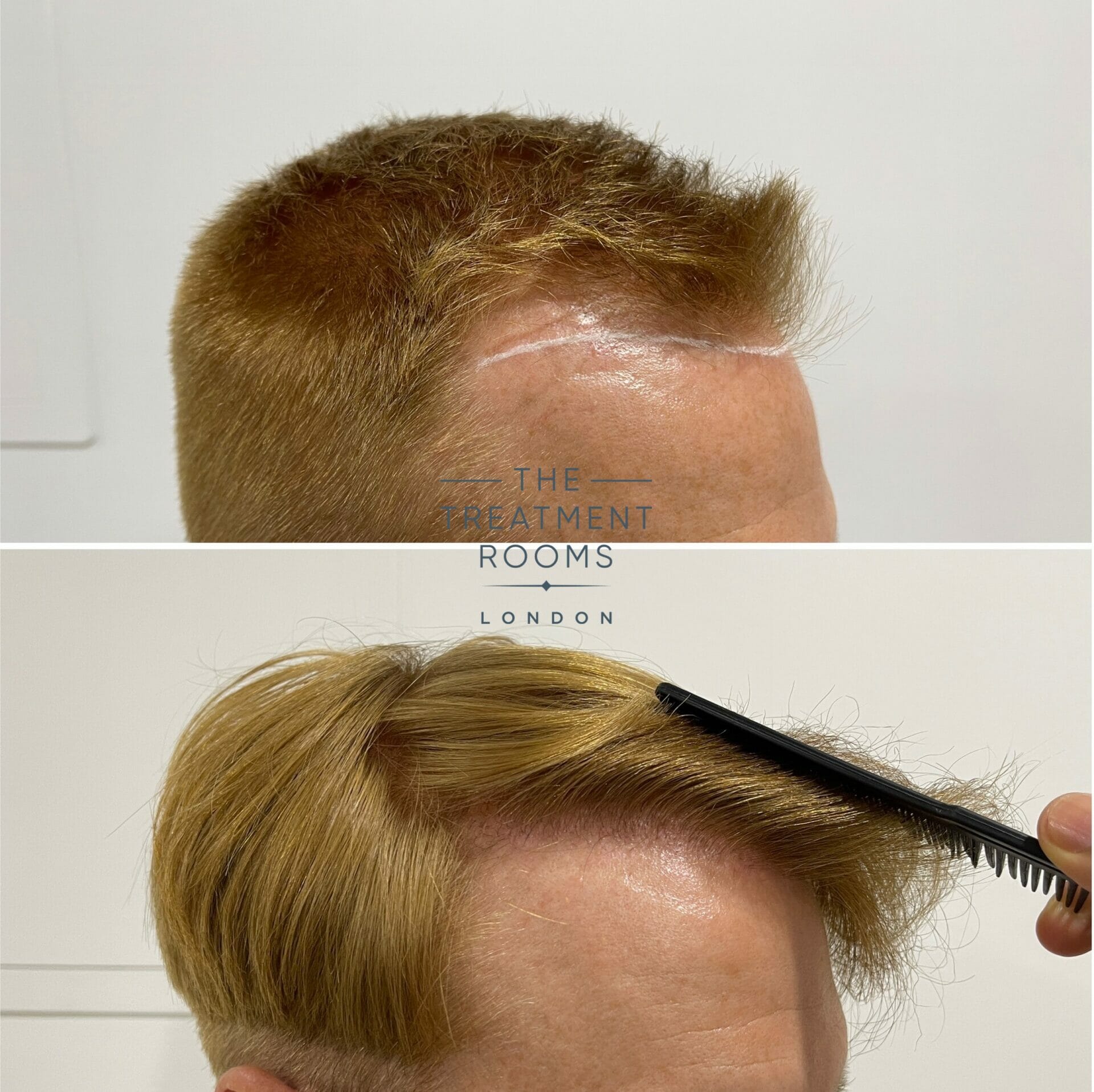 fue hair transplant london 1426 grafts before and after