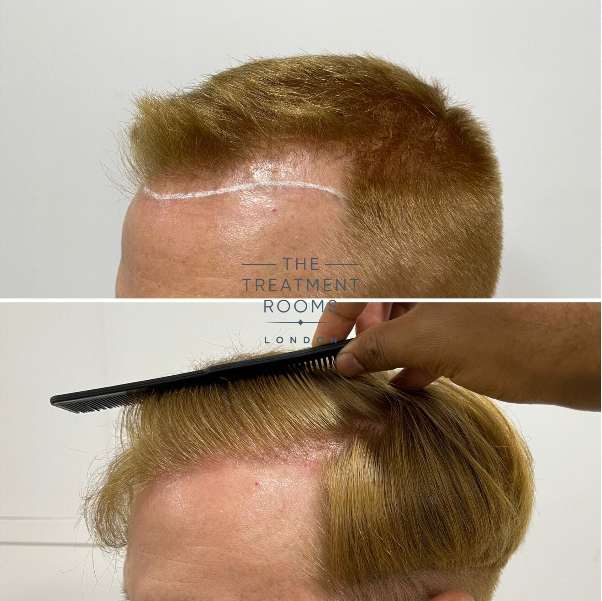 fue hair transplant london 1426 grafts