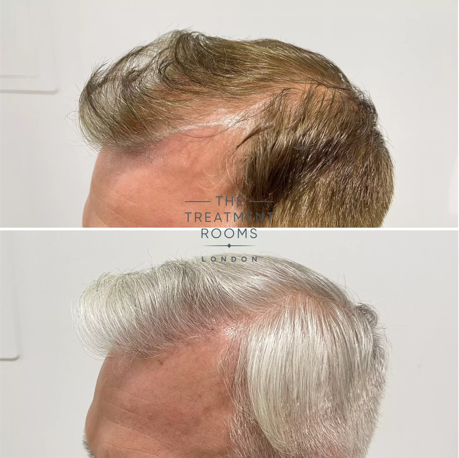 fue hair transplant london 1495 grafts before and after