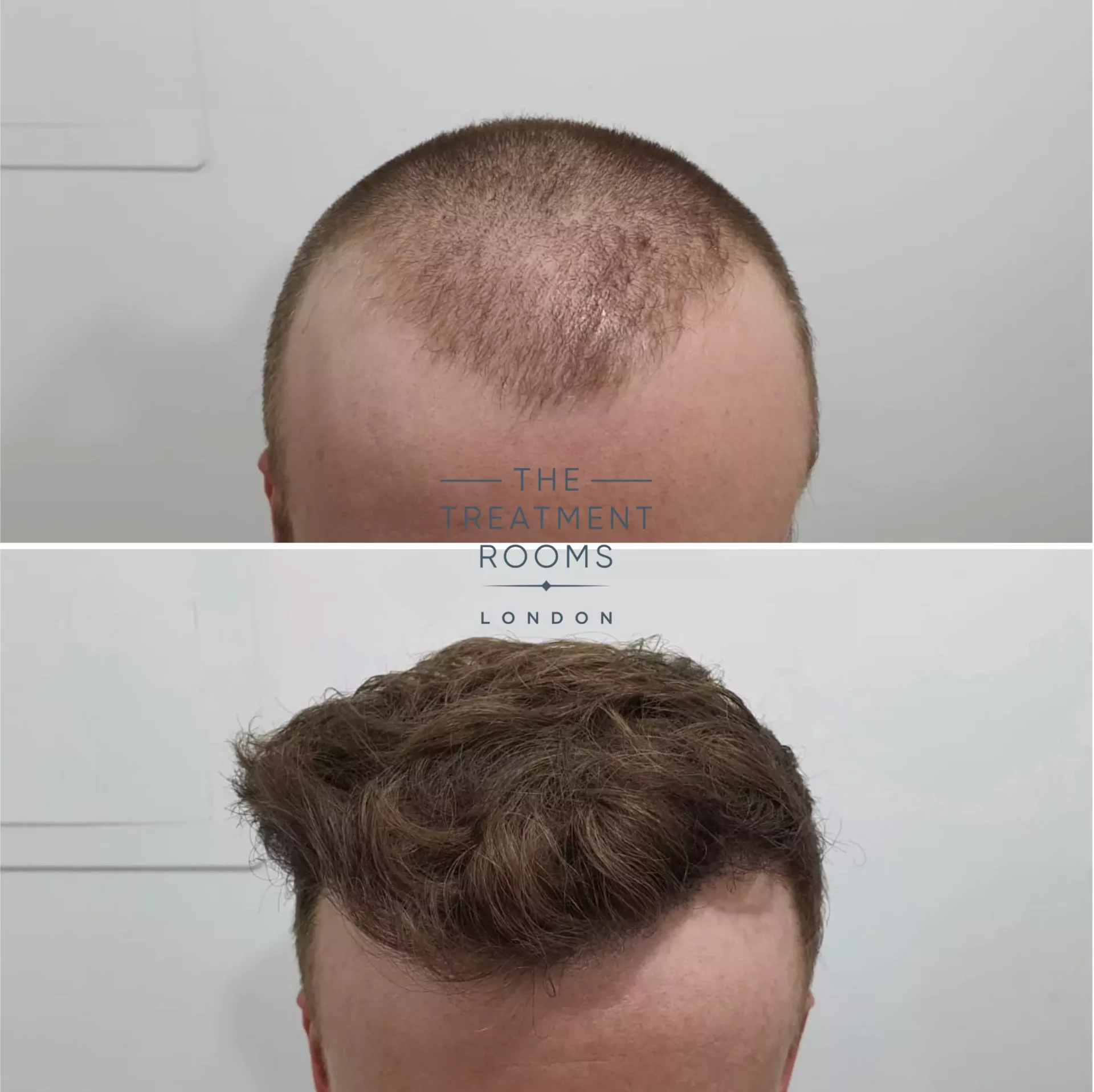 fue hair transplant london 1539 grafts before and after