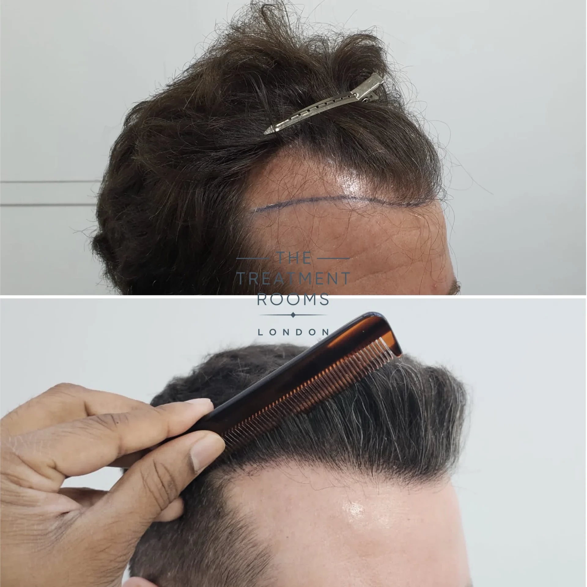 fue hair transplant london 1745 grafts before and after