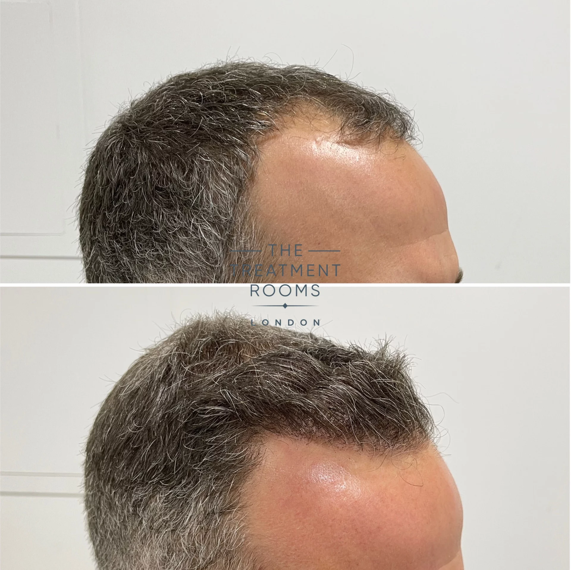 fue hair transplant london 1788 grafts hairline result