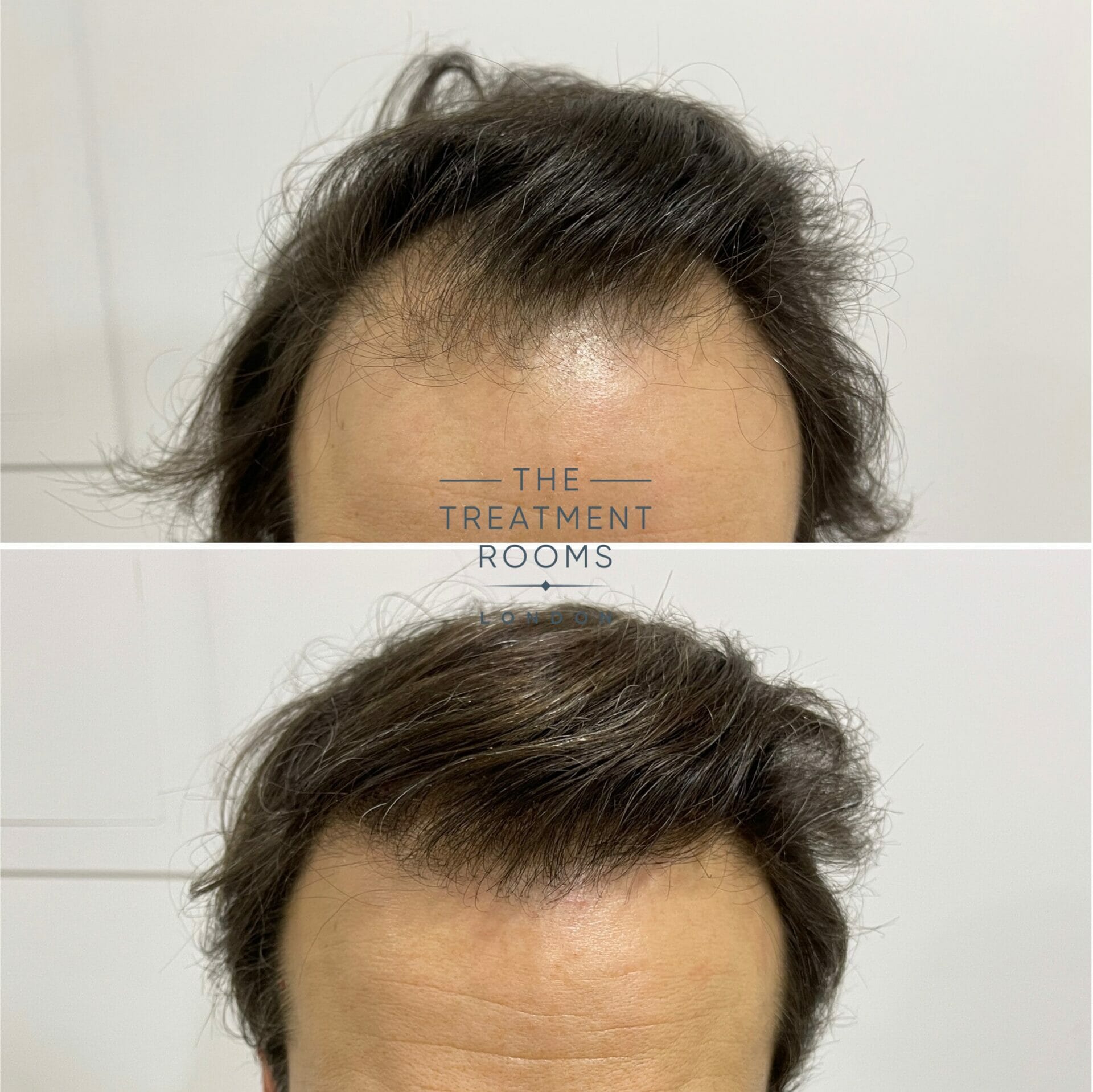 fue hair transplant london 1840 grafts