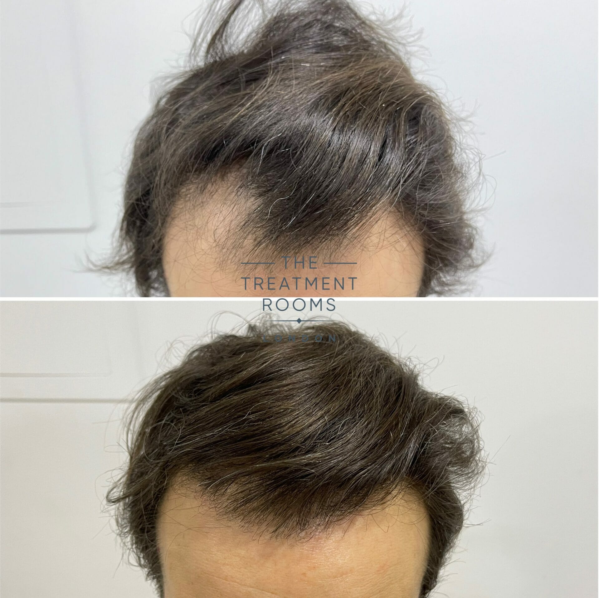 fue hair transplant london hairline 1840 grafts