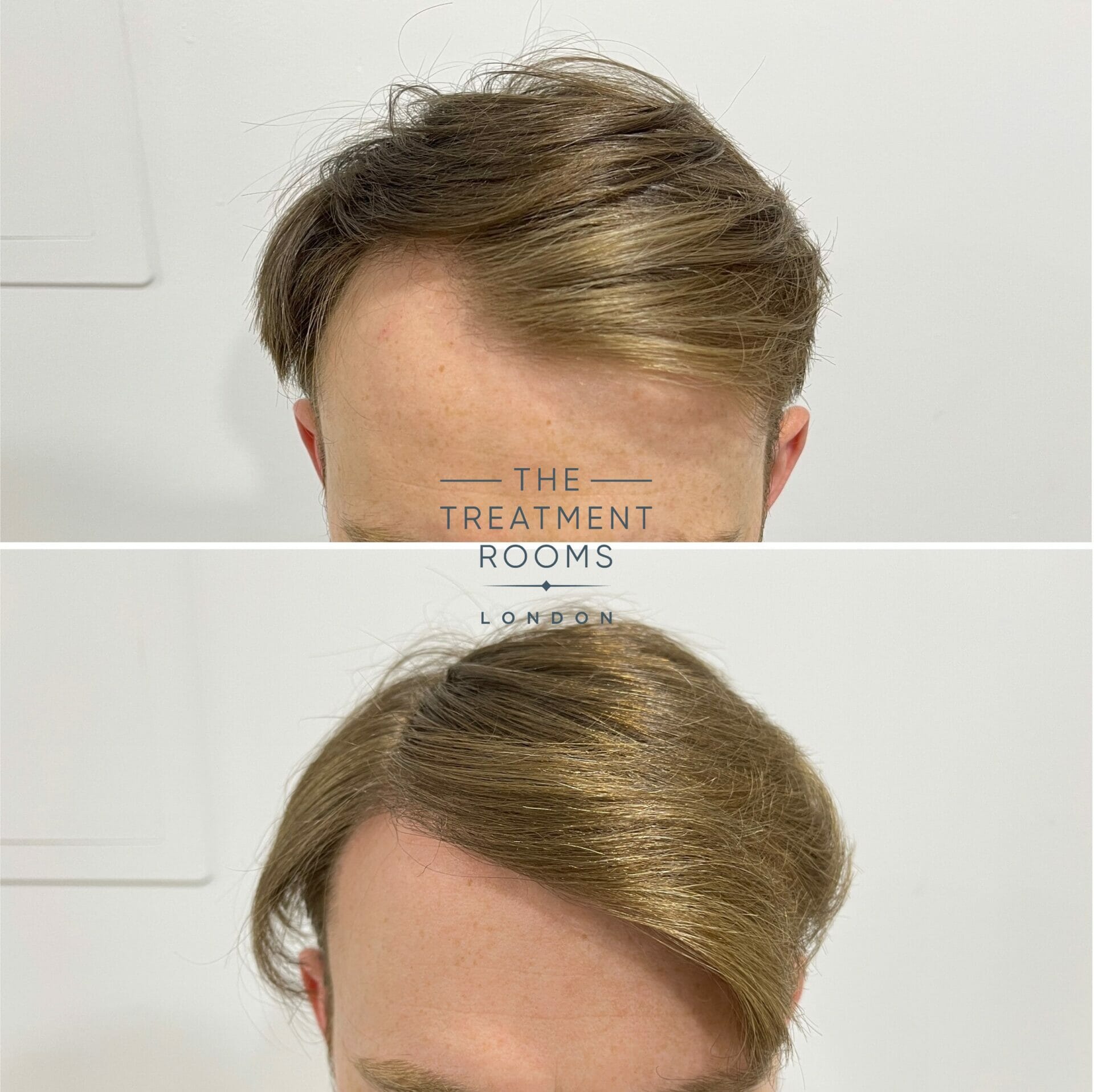 Hair Transplant Before and After 1700 grafts - Treatment Rooms London