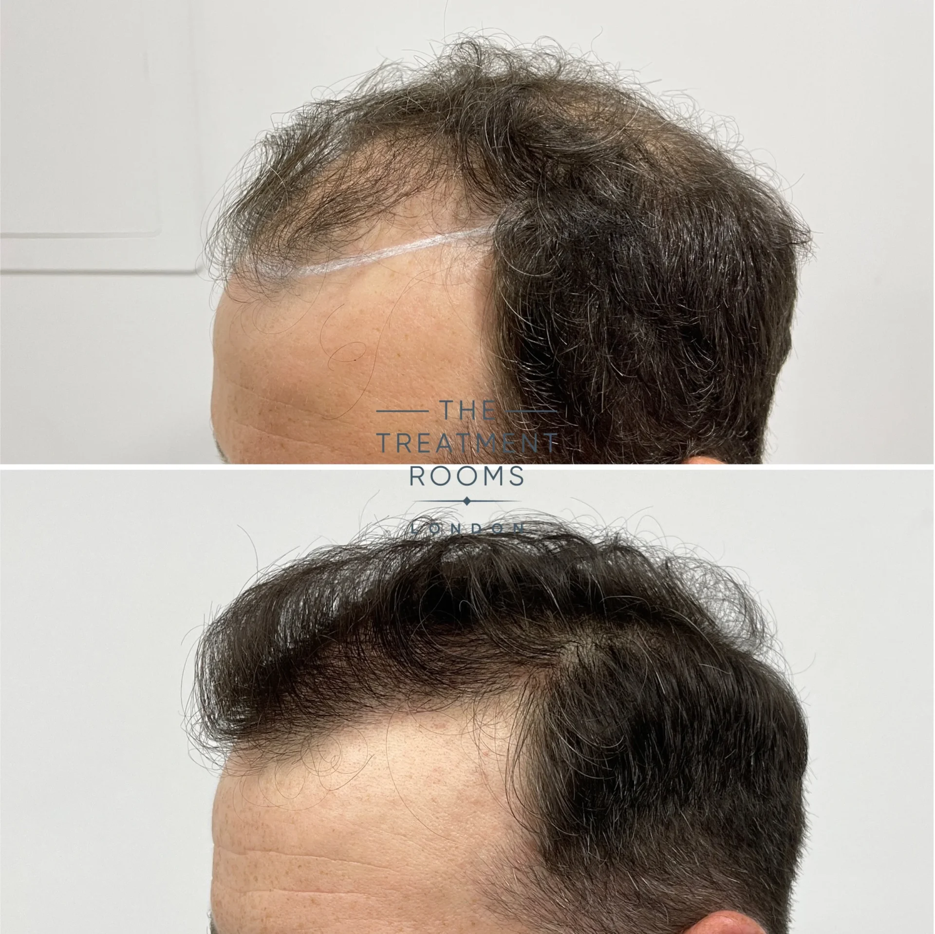 fue hair transplant receding hairline before and after 1521 grafts