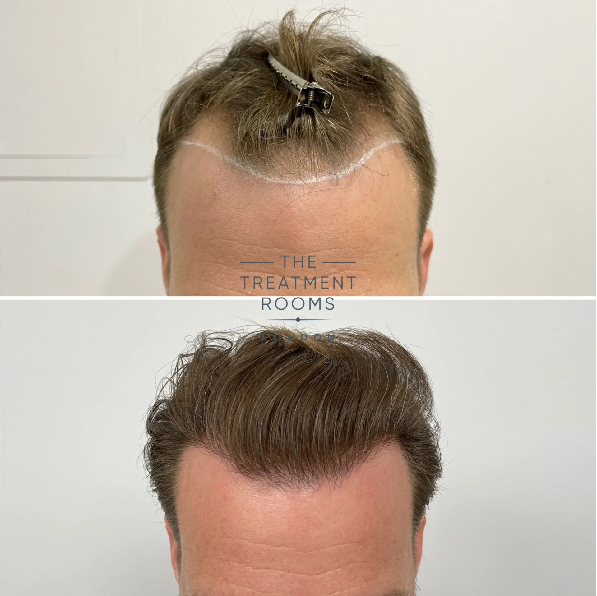 fue hair transplant receding hairline before and after 1566 grafts