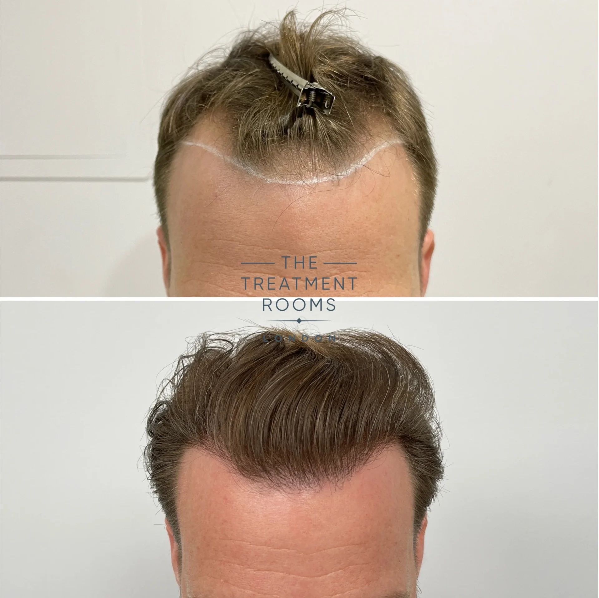 fue hair transplant receding hairline before and after 1566 grafts fue hair transplant receding hairline before and after 1566 grafts
