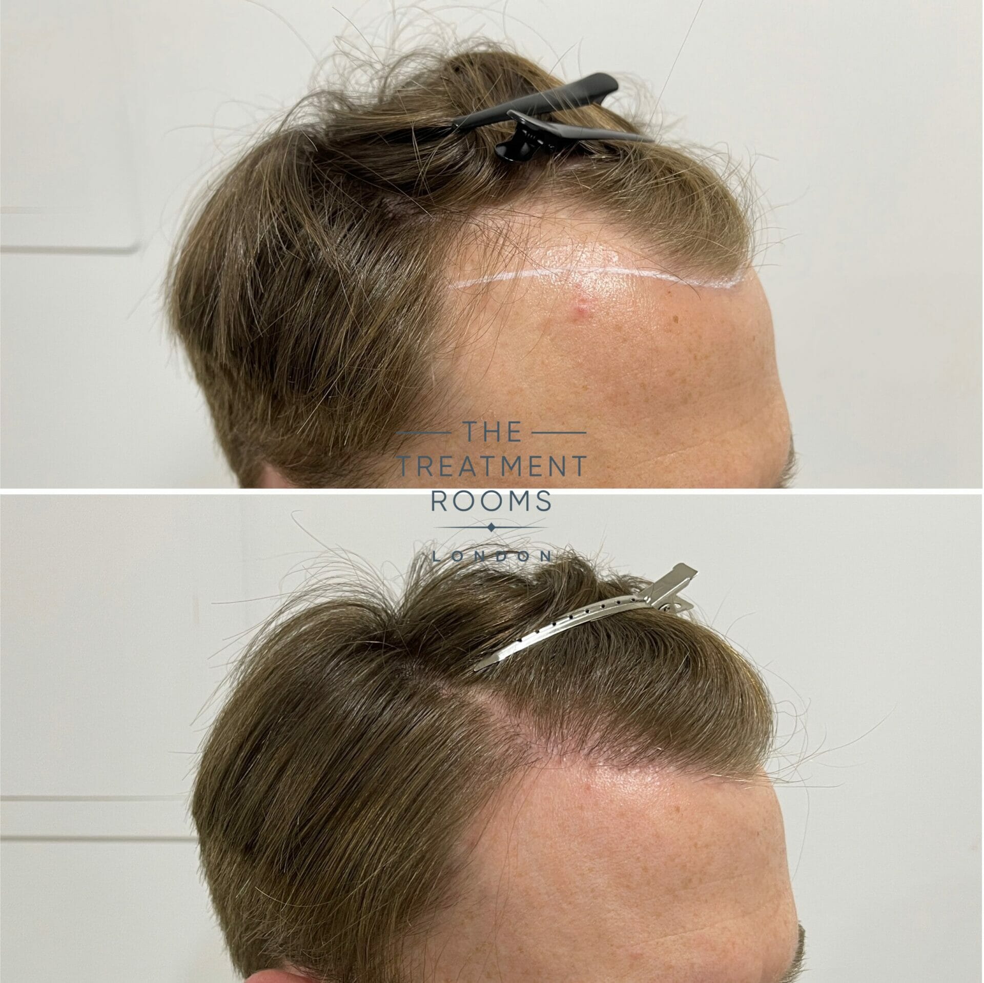 fue hair transplant result 1700 grafts