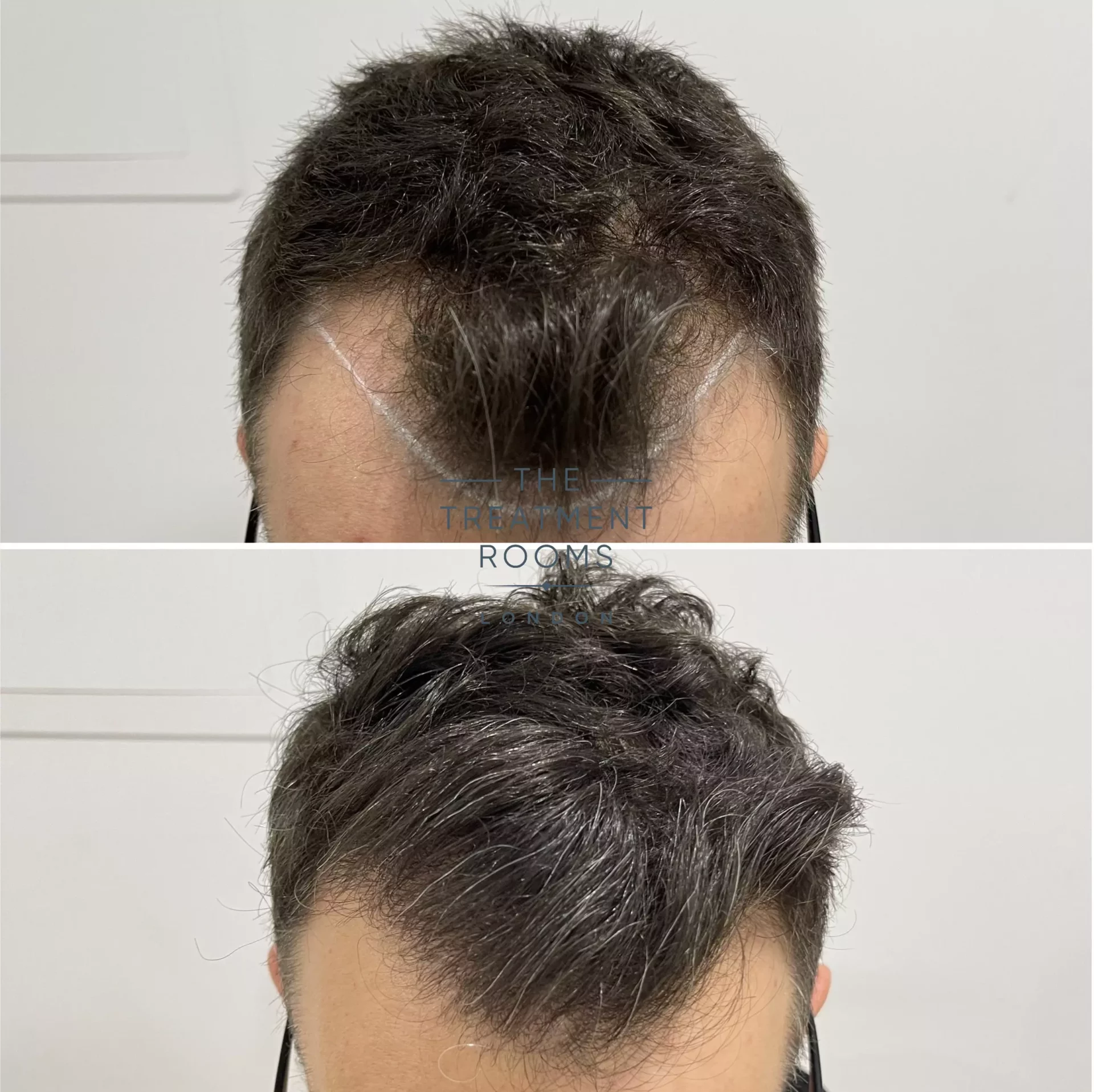 fue hairline transplant london 1321 grafts before and after